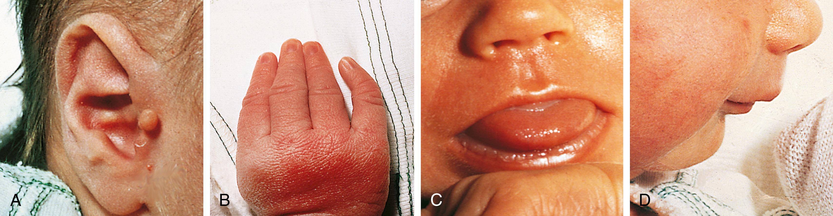 Fig. 1.1, Clinical photographs show several minor anomalies seen at birth. (A) Preauricular skin tag. (B) Clinodactyly of the fifth finger. (C) Macroglossia. (D) Microretrognathia.