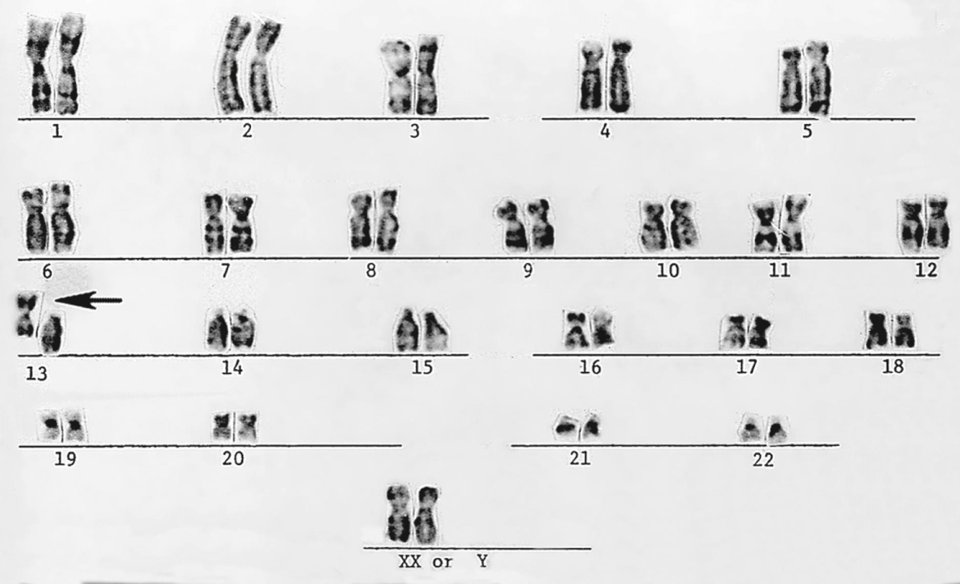 Fig. 1.11, Pericentric inversion (arrow) of chromosome 13.