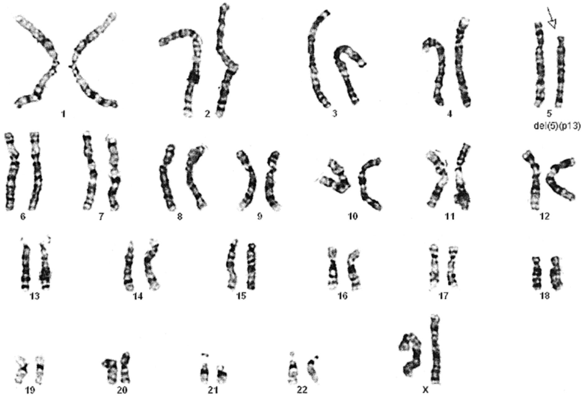 Fig. 1.12, Deletion (arrow) of the p arm of chromosome 5 (cri du chat syndrome).