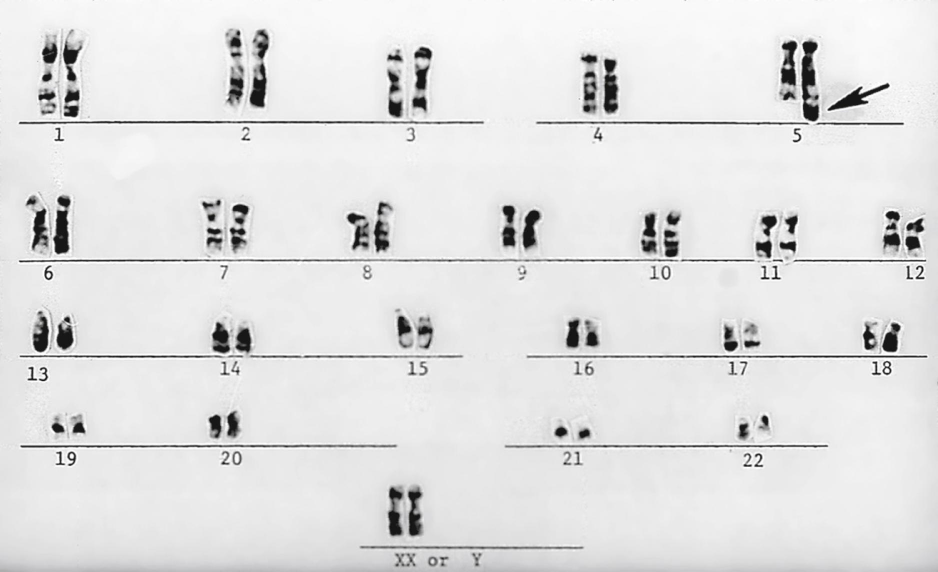 Fig. 1.13, Unbalanced translocation. The additional deoxyribonucleic acid was translocated onto the q arm of chromosome 5 (arrow). The abnormality was inherited from a normal carrier father (see Fig. 1.14 ) with a balanced reciprocal translocation between the q arms of chromosome 3 and chromosome 5. The patient died of multiple birth defects and in essence had a partial trisomy of the distal portion of the q arm of chromosome 3.