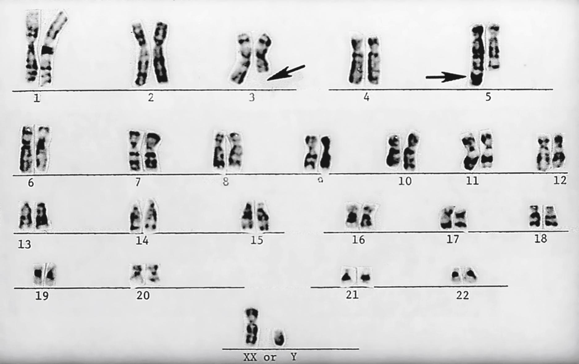 Fig. 1.14, A “balanced” reciprocal translocation from chromosomes 3 (arrow) to 5 (arrow) in a normal man (the father of the chromosomally defective newborn whose karyotype is shown in Fig. 1.13 ).