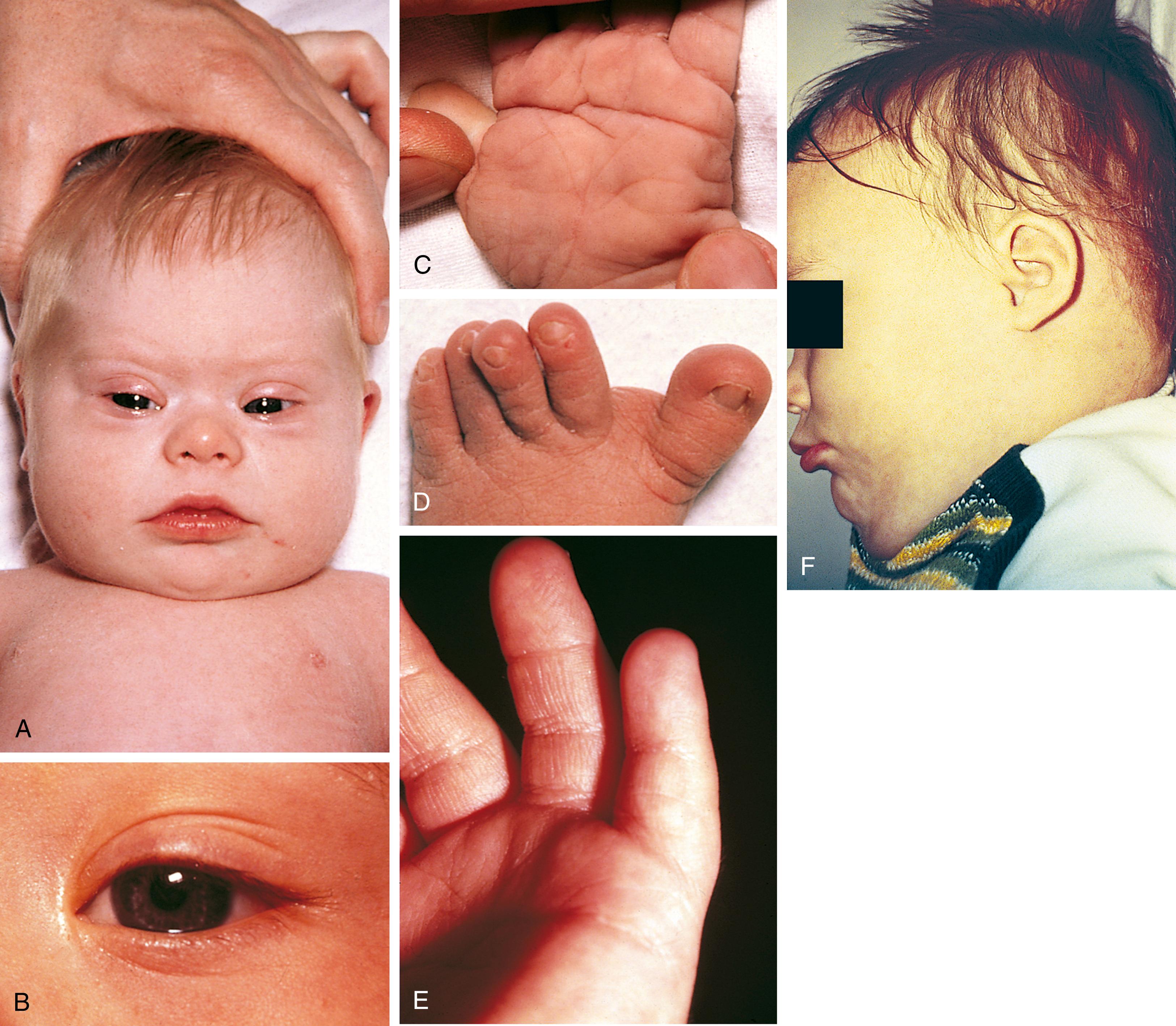 Fig. 1.15, Down syndrome. These clinical photographs show several minor anomalies associated with this disorder. (A) Characteristic facial features with up-slanting palpebral fissures, epicanthal folds, and flat nasal bridge. (B) Brushfield spots. (C) Bridged palmar crease, seen in some affected infants. Two transverse palmar creases are connected by a diagonal line. (D) Wide space between first and second toes. (E) Short fifth finger. (F) Small ears and flat occiput.