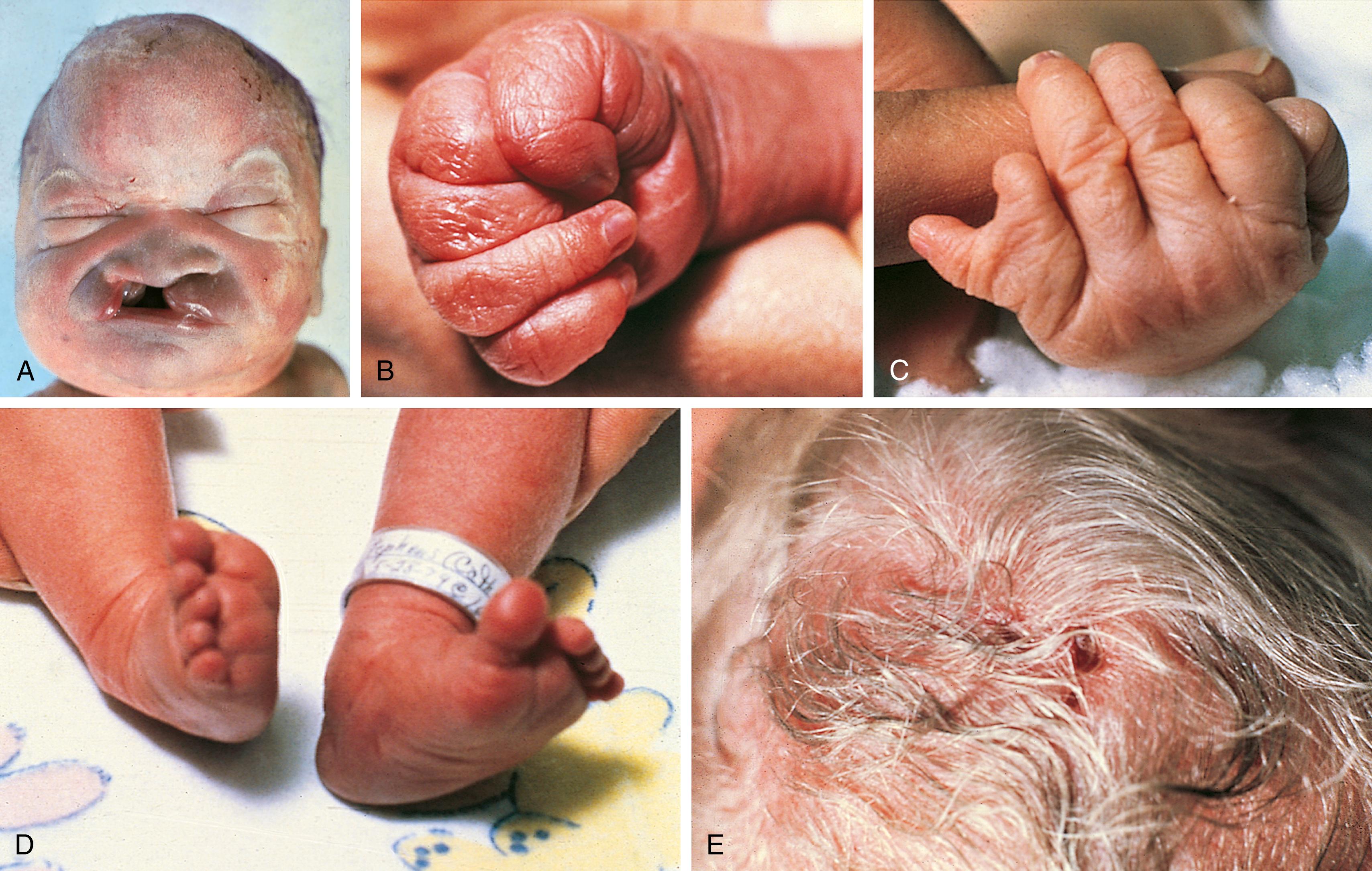 Fig. 1.16, Several physical manifestations of trisomy 13. (A) Facies showing midline defect. (B) Clenched hand with overlapping fingers. (C) Postaxial polydactyly. (D) Equinovarus deformity. (E) Typical punched-out scalp lesions of aplasia cutis congenita.