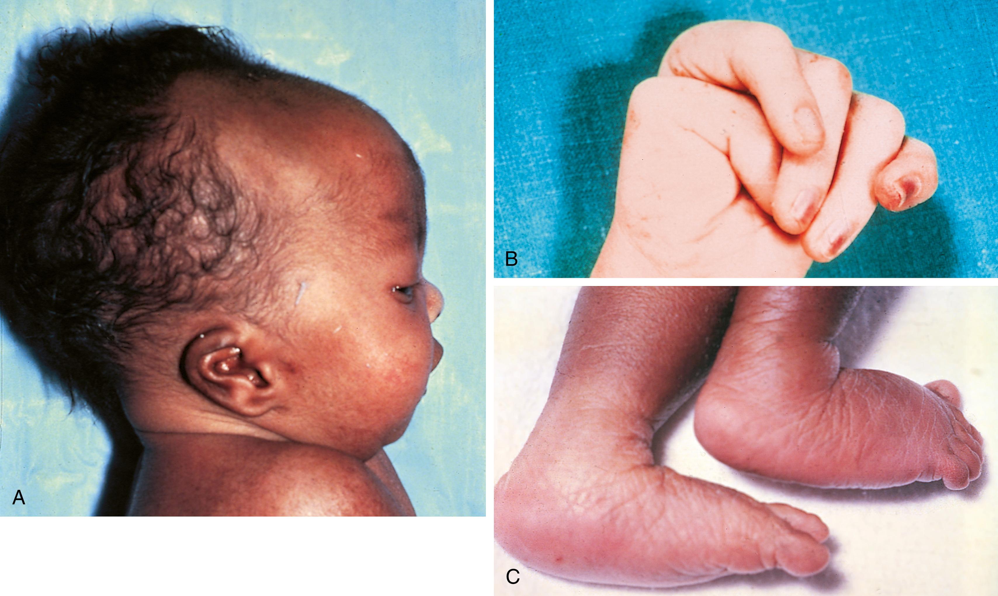 Fig. 1.17, Several physical manifestations of trisomy 18. (A) Typical profile reveals prominent occiput and low-set, posteriorly rotated malformed auricles. (B) Clenched hand showing typical pattern of overlapping fingers. (C) Rocker-bottom feet.