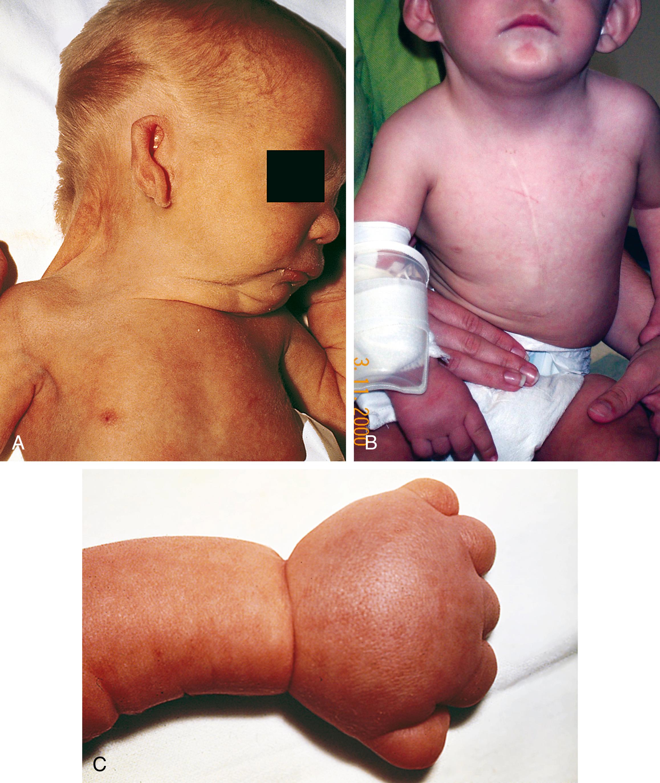 Fig. 1.18, Clinical photographs show several physical manifestations associated with Turner syndrome. (A) In this newborn, a webbed neck with low hairline, shield chest with widespread nipples, abnormal ears, and micrognathia are seen. (B) In this frontal view, mild webbing of the neck and small widely spaced nipples are evident, along with a midline scar from prior cardiac surgery. The ears are low-set and prominent, protruding forward. (C) The newborn shown in (A) also had prominent lymphedema of the hands and feet.