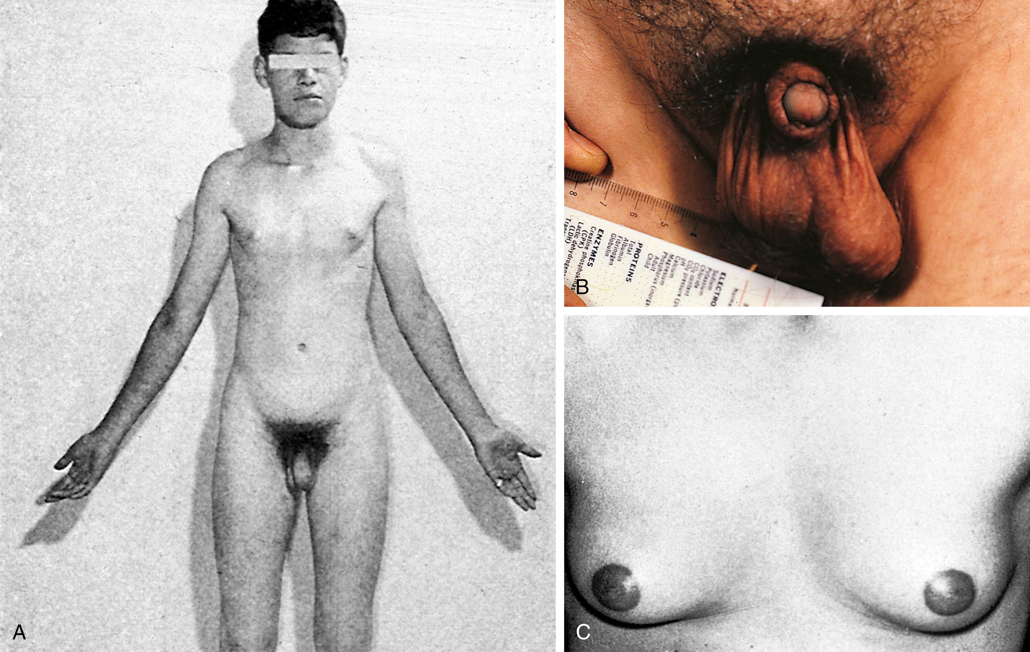 Fig. 1.19, Clinical photographs show several physical manifestations of Klinefelter syndrome. (A) Relatively narrow shoulders, increased carrying angle of arms, female distribution of pubic hair, and normal penis but with small scrotum due to small testicular size. (B) Small testes and penis. (C) Gynecomastia.