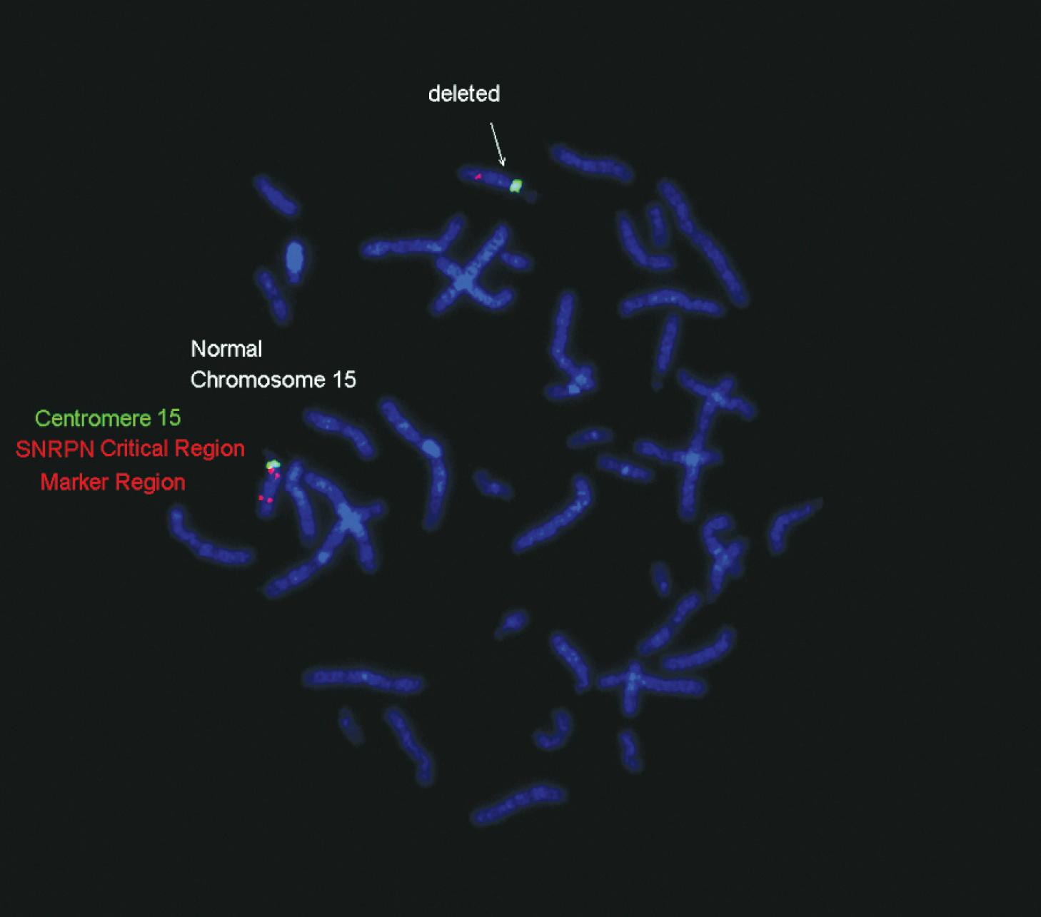 Fig. 1.20, 4′,6′-Diamidino-2-phenylindole–counterstained metaphase and interphase images showing a duplication of the Prader-Willi/Angelman (D15S10 locus) critical region (red). The chromosome 15 centromere is used as a control (green). Adjacent to the centromere in red is the normal pattern for D15S10. SNRPN, Small nuclear ribonucleoprotein-associated polypeptide N.