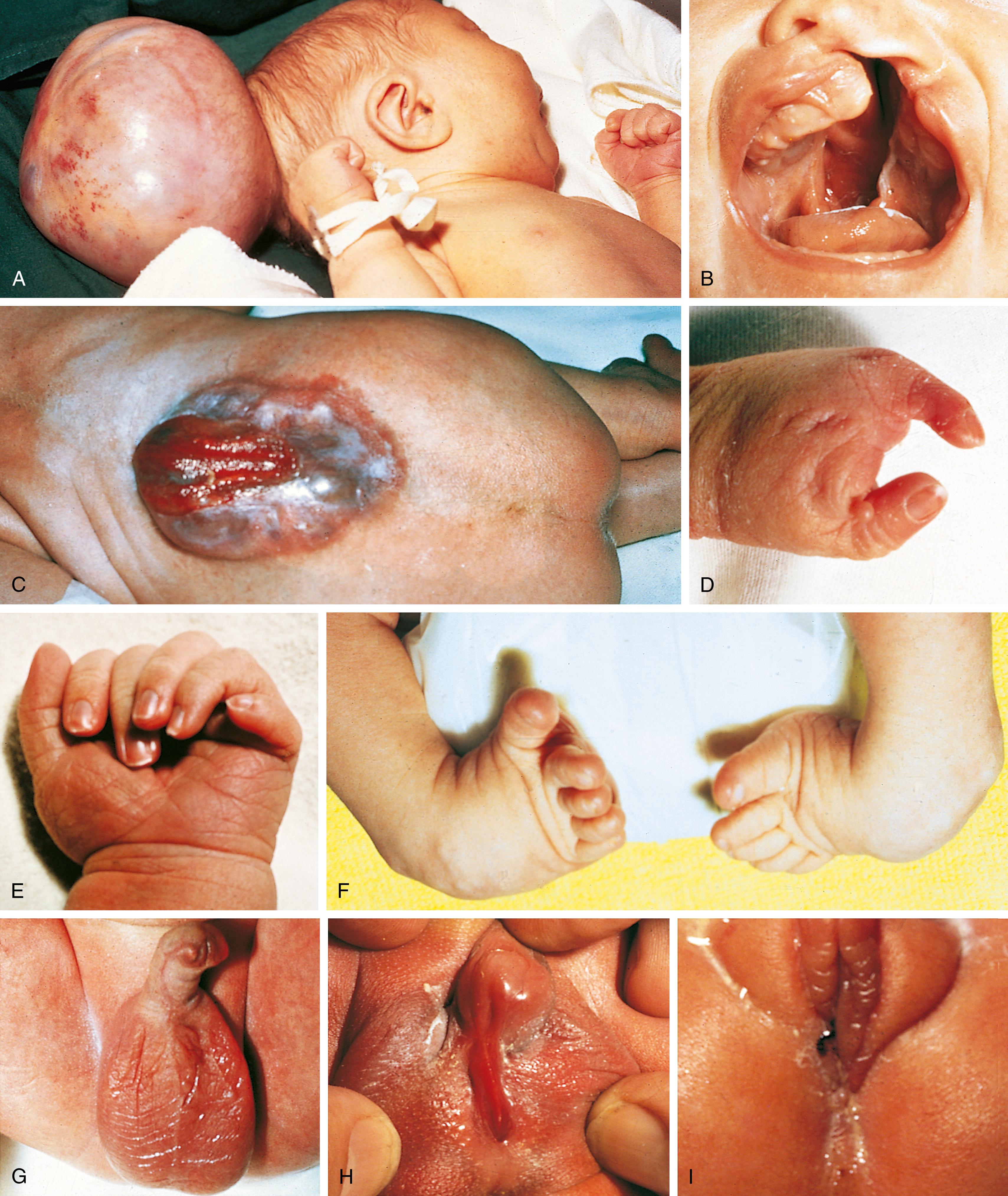 Fig. 1.2, Clinical photographs show several major anomalies seen at birth. (A) Encephalocele. (B) Cleft lip and palate. (C) Meningomyelocele. (D) Ectrodactyly (previously termed lobster-claw deformity ). (E) Polydactyly (postaxial). (F) Bilateral clubfoot. (G) Hypospadias. (H) Fused labia with enlarged clitoris. (I) Imperforate anus.