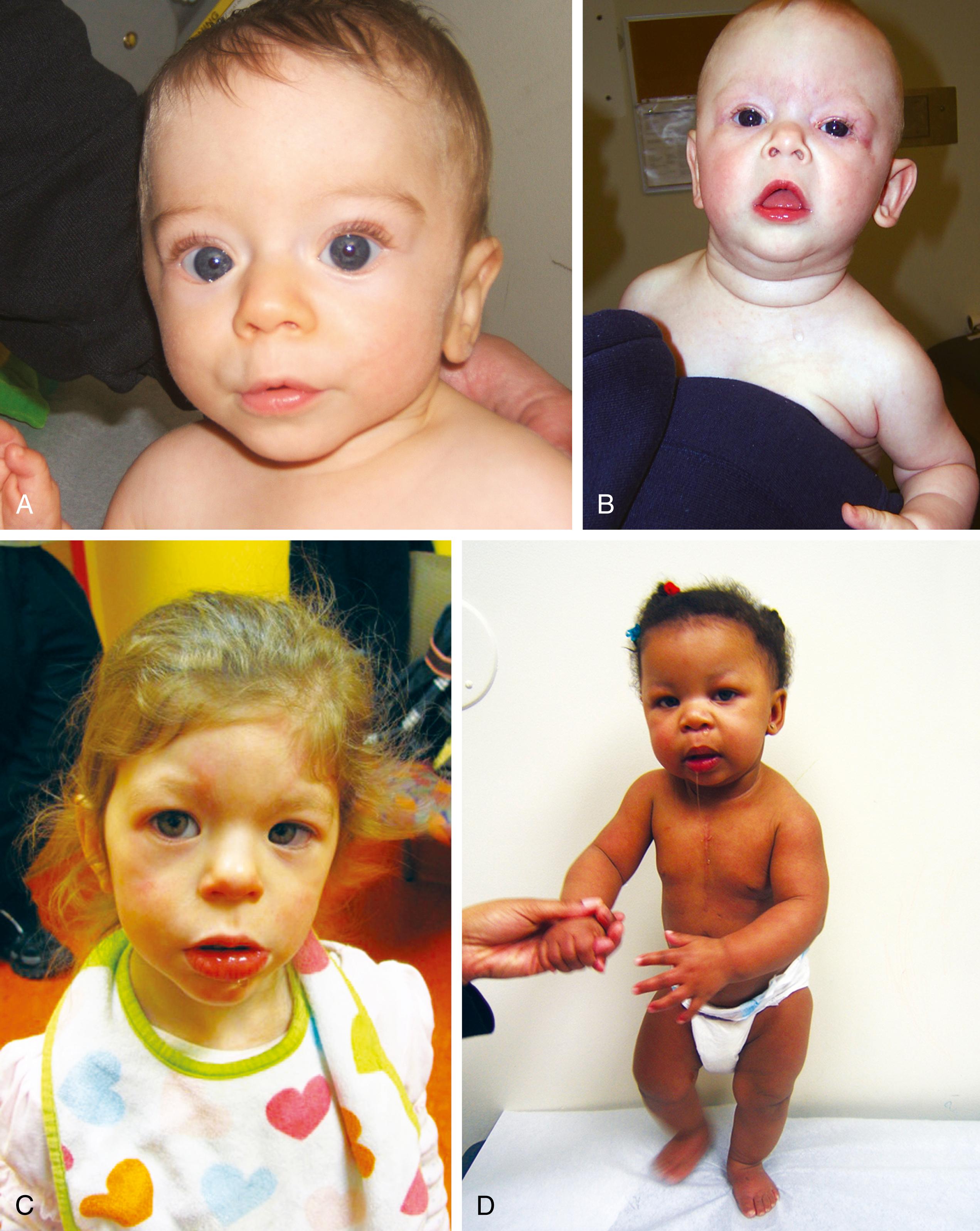 Fig. 1.21, (A–D) Williams syndrome in four different patients. Hallmark features include supravalvular aortic stenosis, hypercalcemia, friendly personality, connective tissue abnormalities, and characteristic facies. Note the periorbital fullness, epicanthal folds, prominent lips, long philtrum, and stellate lacy iris pattern. All cases with clinical features were confirmed on fluorescence in situ hybridization alone or microarray.