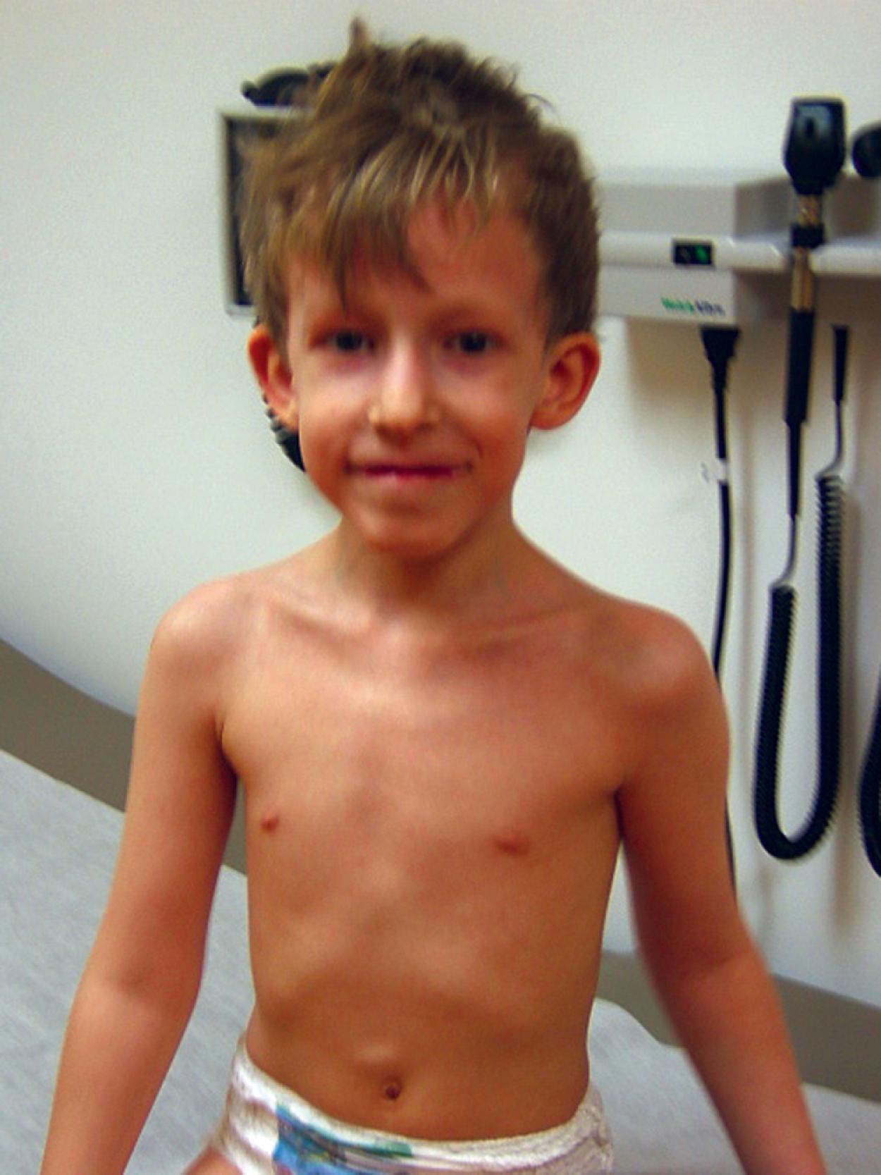 Fig. 1.22, An 8-year-old with del22q.11 and 1p31.1 microdeletion. Patient is short in stature; has a right aortic arch, sacral dimple, left cryptorchidism, and global developmental and significant cognitive and speech delays; and is not toilet trained. He had undergone surgical repair of the palate for velopharyngeal incompetence. Note the low-set, cupped, and posteriorly rotated ears and hypoplastic alae nasi. DiGeorge syndrome was diagnosed in utero by prenatal FISH on amniocytes: 46, XY, ish del(22) (q11.2q11.2) (TUPLE1–) was confirmed at 6 years of age by oligonucleotide arrays. In addition, 1p31.1 microdeletion was detected and maternally inherited.