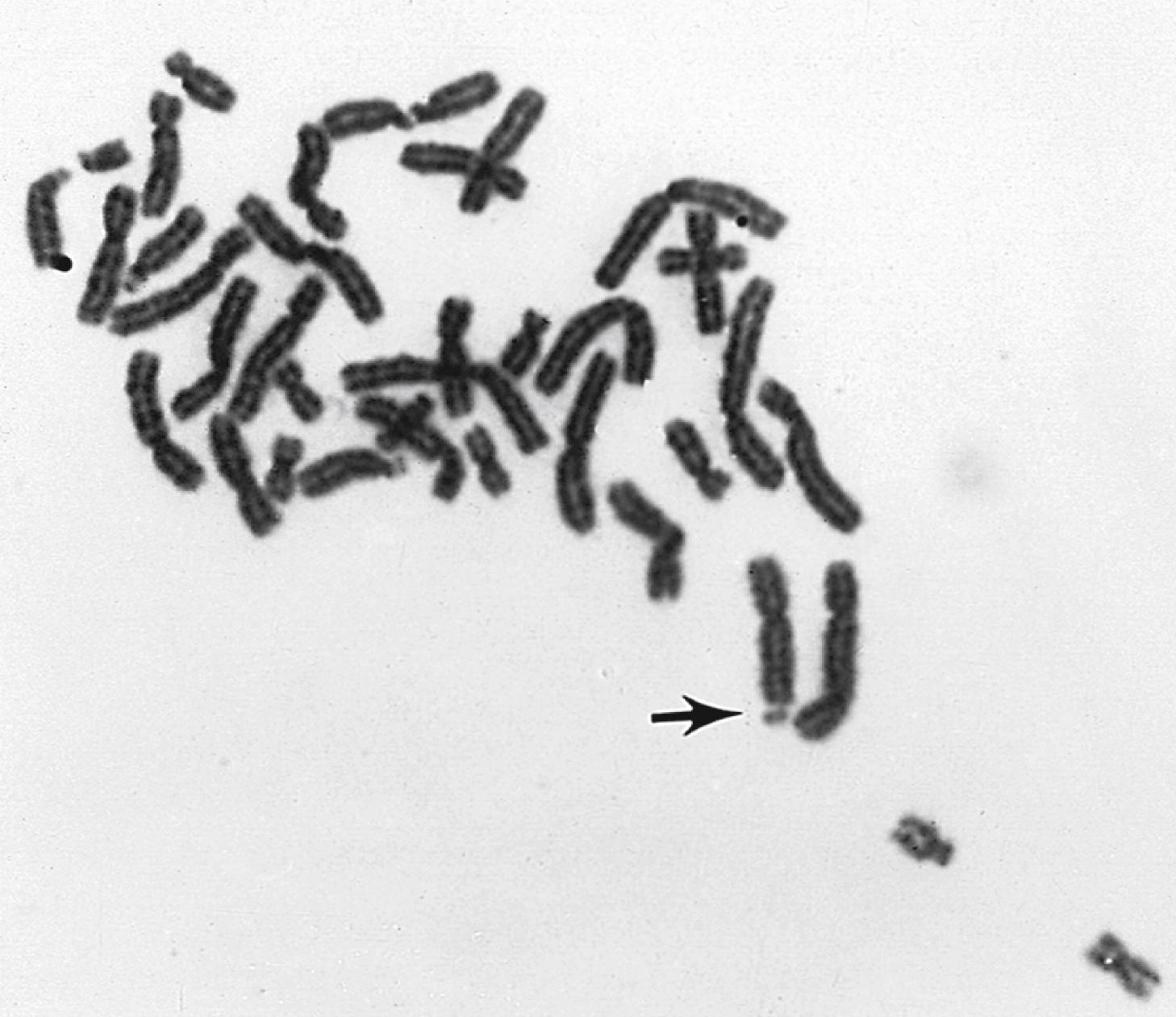 Fig. 1.23, Fragile X chromosome marker in lymphocyte culture. Partial metaphase plate shows the chromosome break at Xq27 (arrow) characteristic of fragile X syndrome (solid Giemsa stain).