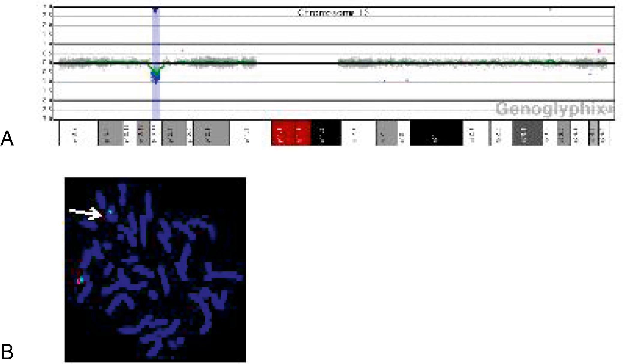 eFig. 1.3, (A) Microarray characterization of 16p13.11 deletion. Microarray plot shows a single-copy loss of 170 oligonucleotide probes from the short arm of chromosome 16 at 16p13.11. Probes are ordered on the x axis according to physical mapping positions, with the most distal p-arm probes to the left and the most distal q-arm probes to the right. Values along the y axis represent log 2 ratios of patient: control signal intensities. Results are visualized with Genoglyphix software (Signature Genomics, Spokane, WA). (B) Fluorescence in situ hybridization showing a deletion at 16p13.11. Probe 16p13.11 is labeled in red, and chromosome 16 centromere probe D16Z2 is labeled in green as a control. The presence of only one red signal indicates deletion of 16p13.11 on one homologue (arrow).