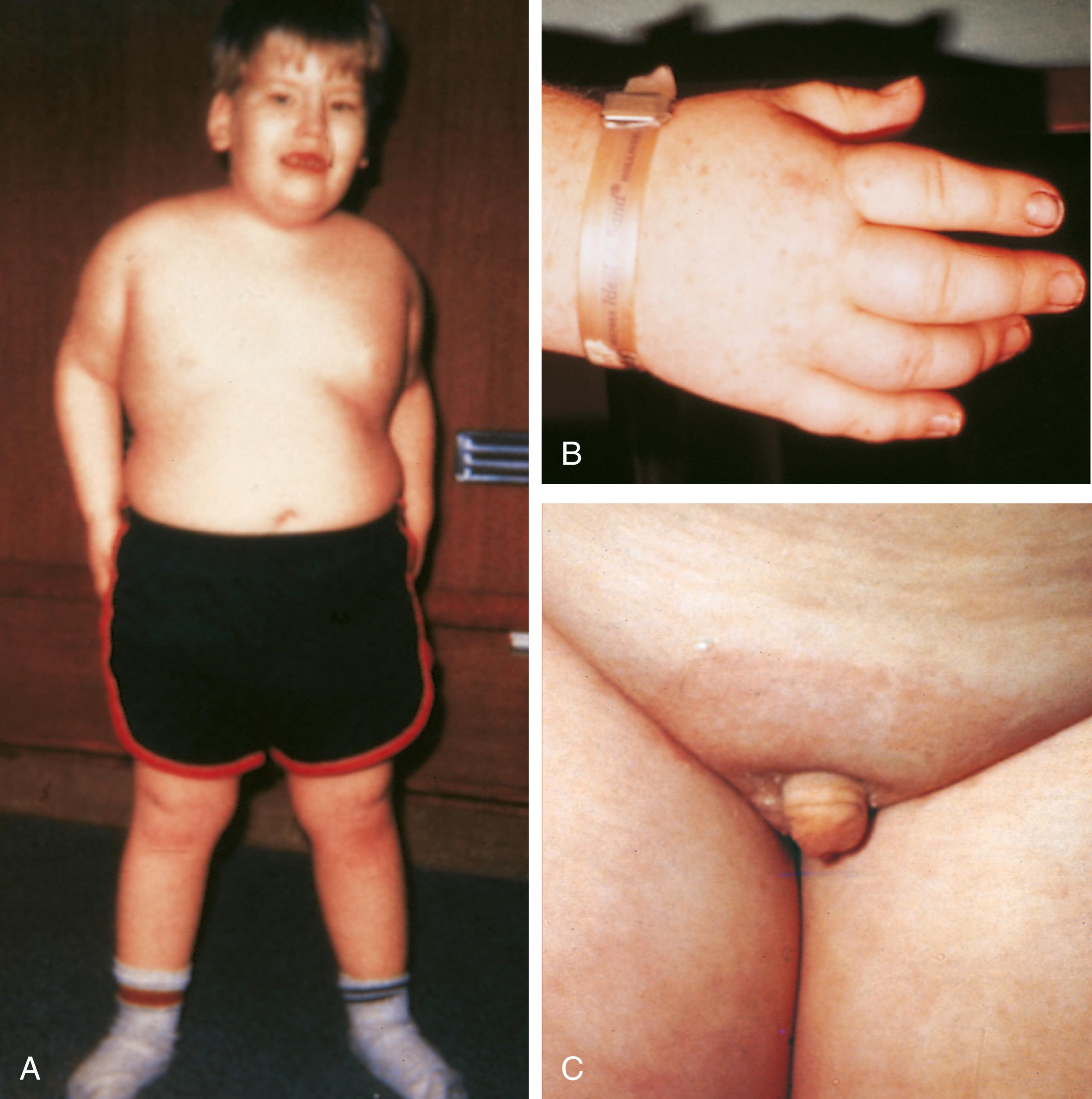 Fig. 1.26, Prader-Willi syndrome. (A) This patient demonstrates the marked obesity characteristic of Prader-Willi syndrome. Excess fat is distributed over the trunk, buttocks, and proximal extremities. (B and C) Small hands (and feet) and a hypoplastic penis and scrotum are other typical features.
