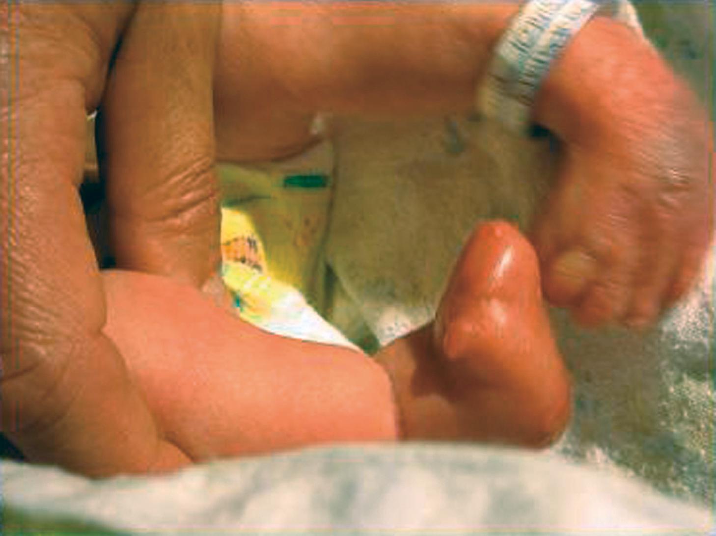 Fig. 1.3, Amniotic band syndrome; note the constriction ring at the ankle and amputation of the toes, a sequela to the amniotic bands.