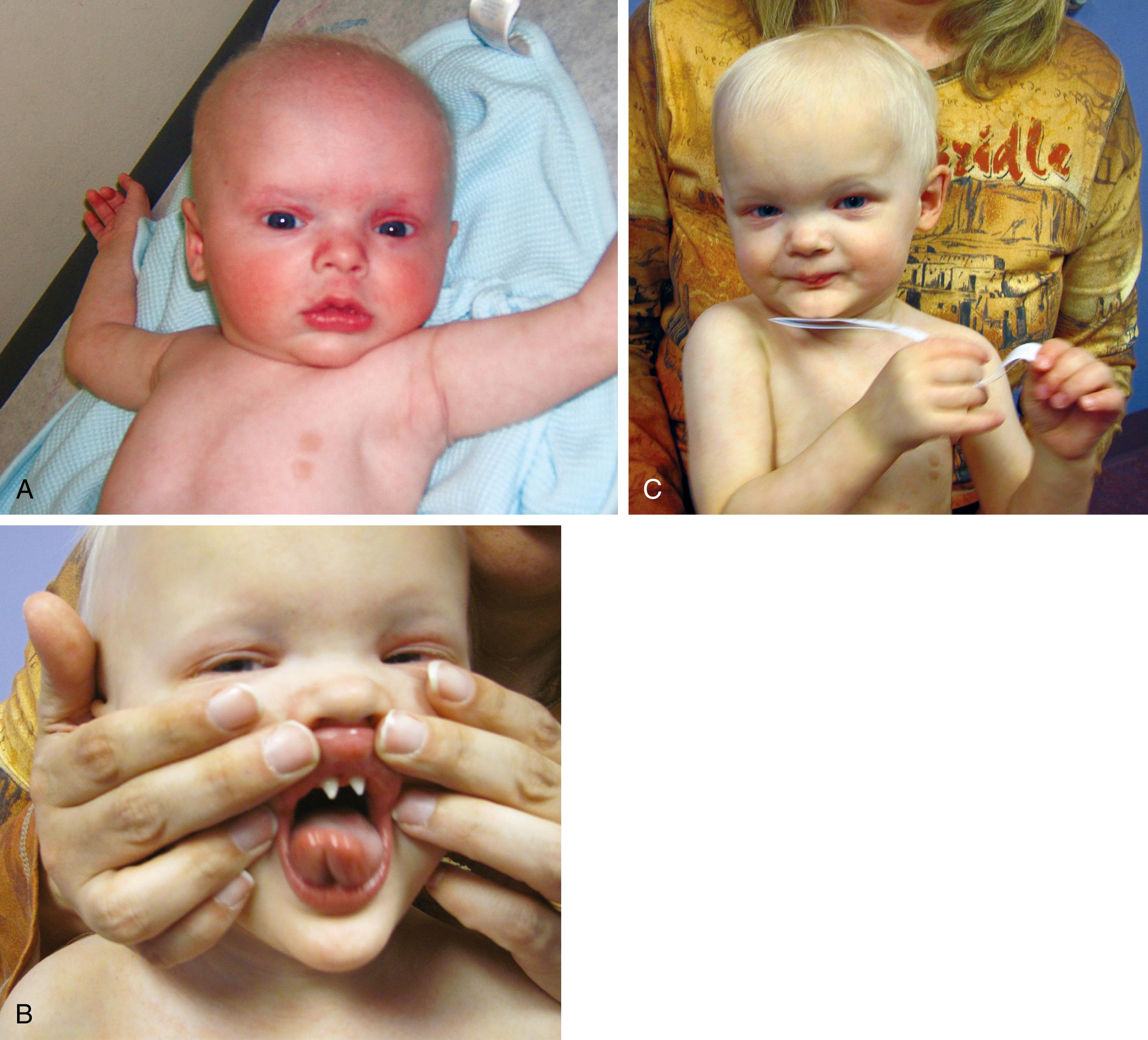 Fig. 1.28, Classic presentation for features of X-linked recessive hypohidrotic ectodermal dysplasia at 1 to 20 months of age. At 1 month the infant was admitted to “rule out sepsis” with high fever, but the workup was negative. (A) Note the thin, sparse, fine hair. (B) Severe hypodontia and anterior conical teeth. (C) Low nasal bridge, periorbital wrinkling, full forehead, prominent lips, and prominent supraorbital ridges. Sequencing of the EDA1 gene showed the missense pathogenic variant and confirmed the clinical diagnosis. The mother and her maternal female relatives have variable and milder clinical features.