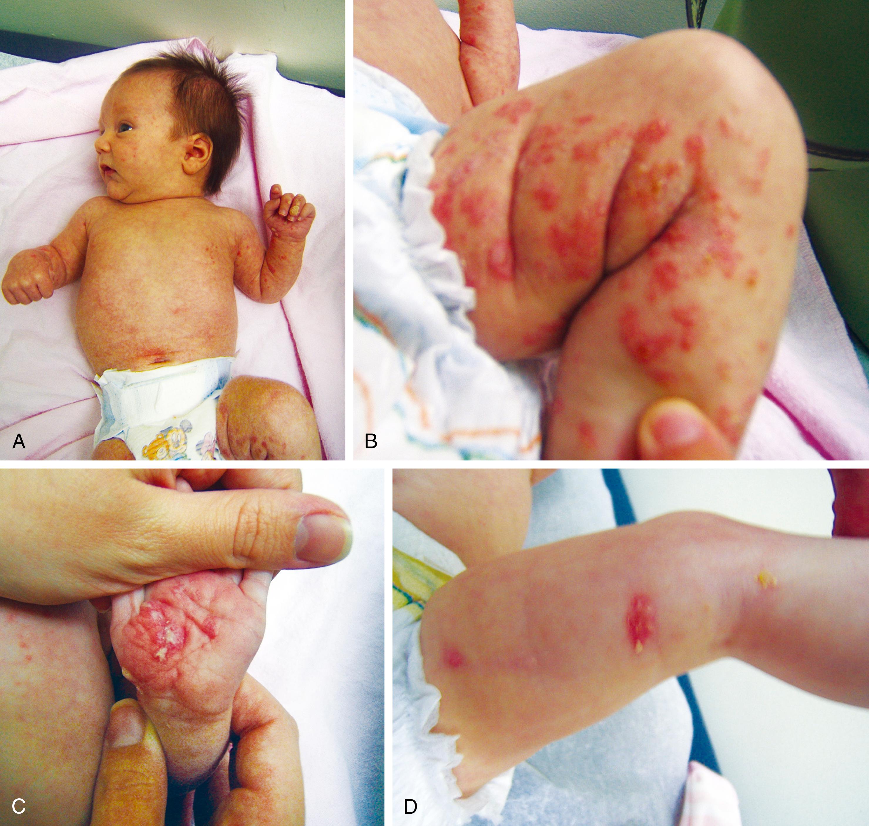 Fig. 1.29, Incontinentia pigmenti syndrome. (A–C) At 7 weeks old this patient manifested erythema, and blisters on the trunk and extremities. Hyperkeratotic lesions have already started. This X-linked dominant condition is typically lethal in males. One-third of the patients have psychomotor delays, microcephaly, and seizures, which were not observed in this patient. Pathogenic variant(s) in the NEMO gene at Xq28 are encountered in the majority of patients. By 5 months old, the rash was already resolving. (D) Rash replaced with hyperpigmentation on the trunk and pale hairless patches or streaks subsequently on the lower limbs. Patient was confirmed to have intragenic microdeletion of the NEMO gene, involving exons 4 through 10.
