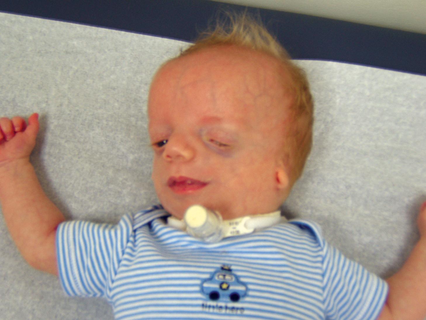 Fig. 1.31, A 4-month-old male with classic features of Treacher Collins syndrome. Note the down-slanted palpebral fissures, malar hypoplasia, malformed auricle, and mandibular hypoplasia. The pathogenic variant was identified as a single sequence variation (c.2897insC) in the TCOF1 gene that introduces a premature stop codon.