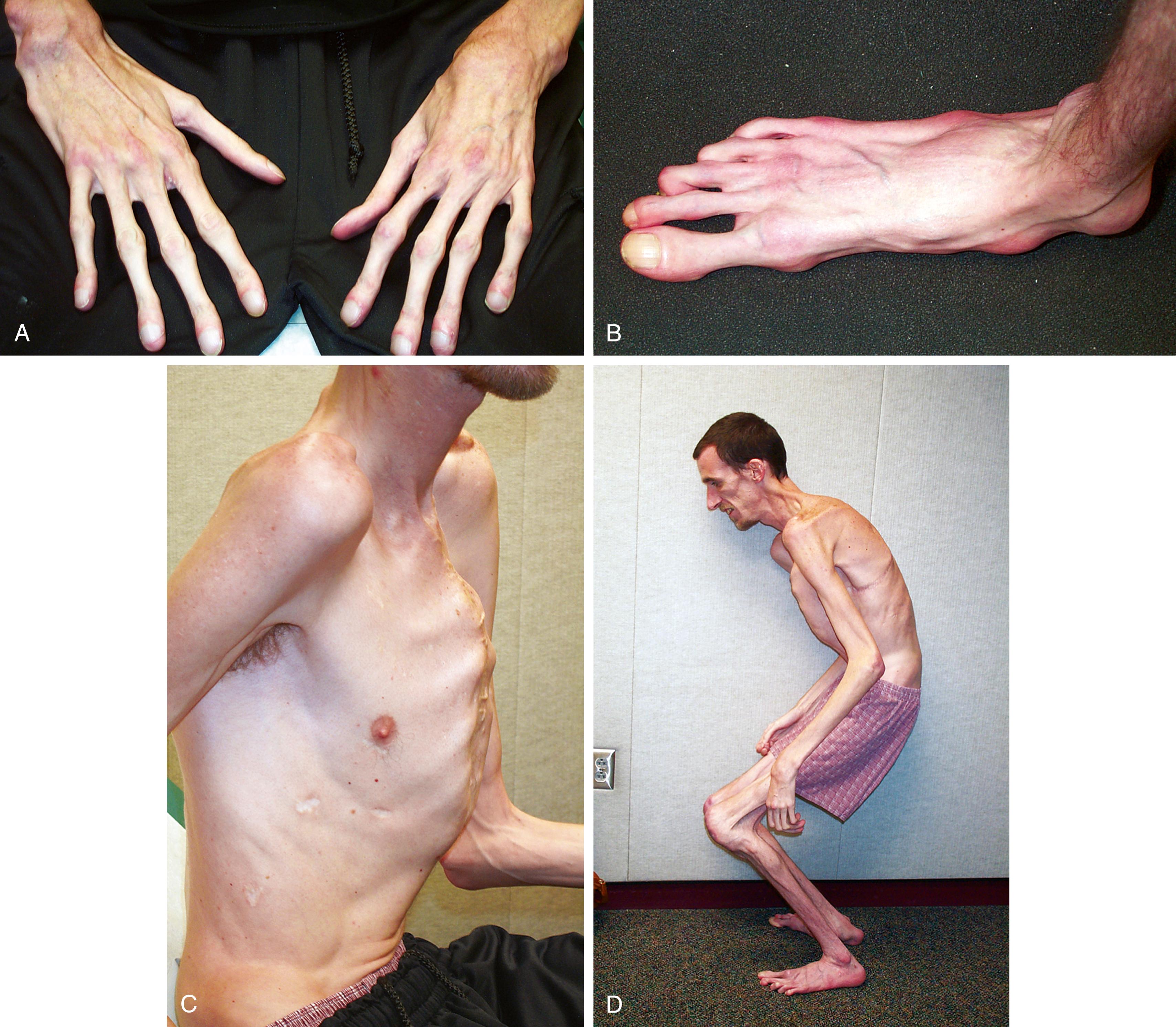 Fig. 1.32, Marfan syndrome. (A and B) This young man has prominent arachnodactyly of both fingers and toes. Note the clubbing due to associated cardiopulmonary problems and the flattening of the arch of his foot. He also has severe pectus carinatum (C) and significant kyphosis and joint contractures (D). Also note his long arms.