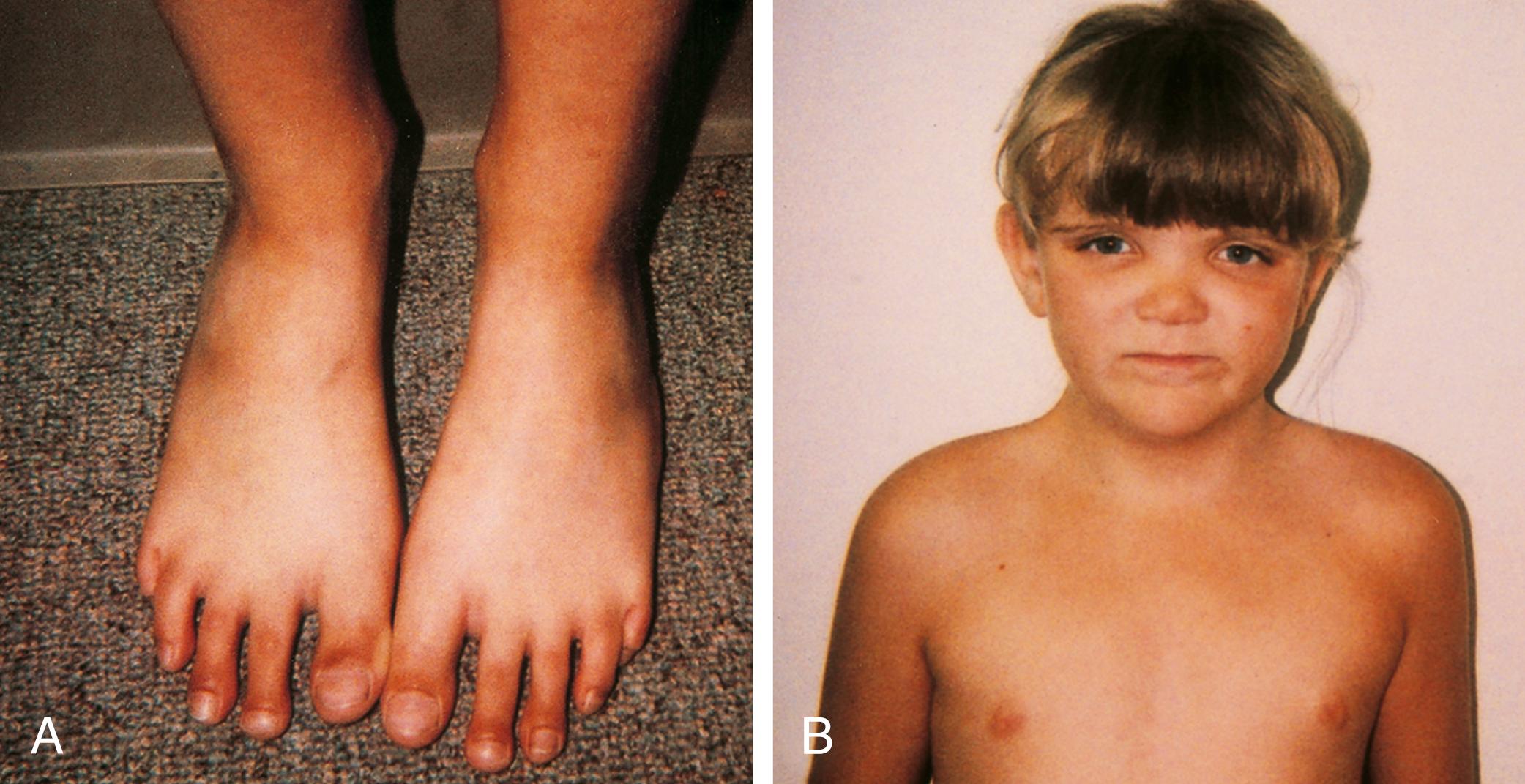 Fig. 1.35, Beals syndrome variant. This child was found to have an abnormality of fibrillin-2 secretion in fibroblasts. (A) She was tall and had arachnodactyly with contractures. (B) Her broad forehead and hypertelorism are physical features that help distinguish her case from classic Beals syndrome and Marfan syndrome.