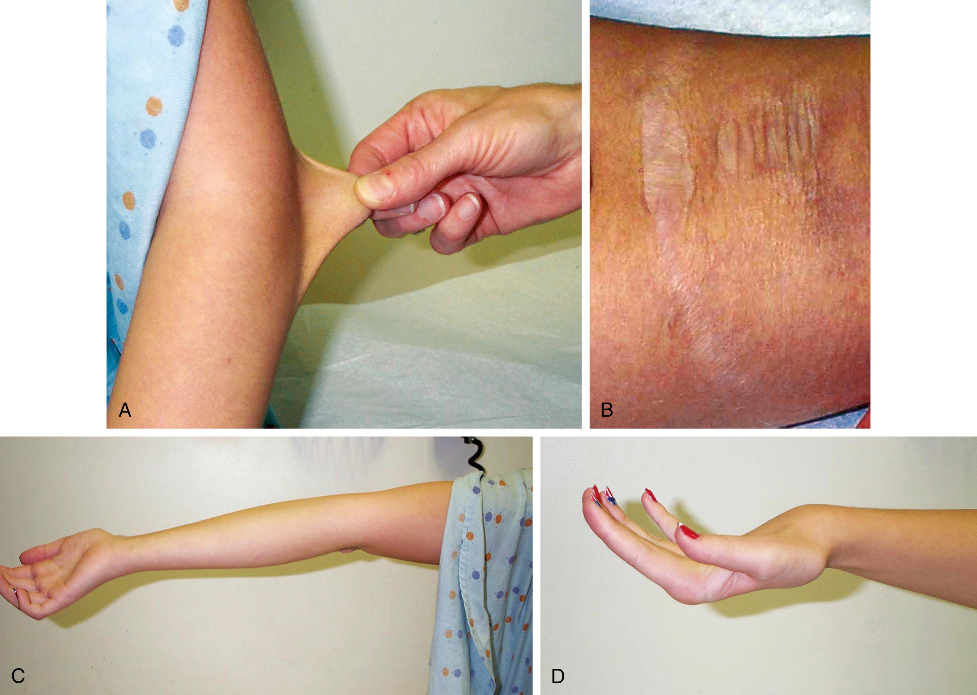 Fig. 1.36, Ehlers-Danlos syndrome (EDS)—classic type. (A) Note the marked hyperextensibility of the skin over this child’s arm. (B) These widened atrophic scars have the thin papery texture that is characteristic of EDS. (C and D) Hyperextensibility of the joints of the elbow and fingers is seen as well.