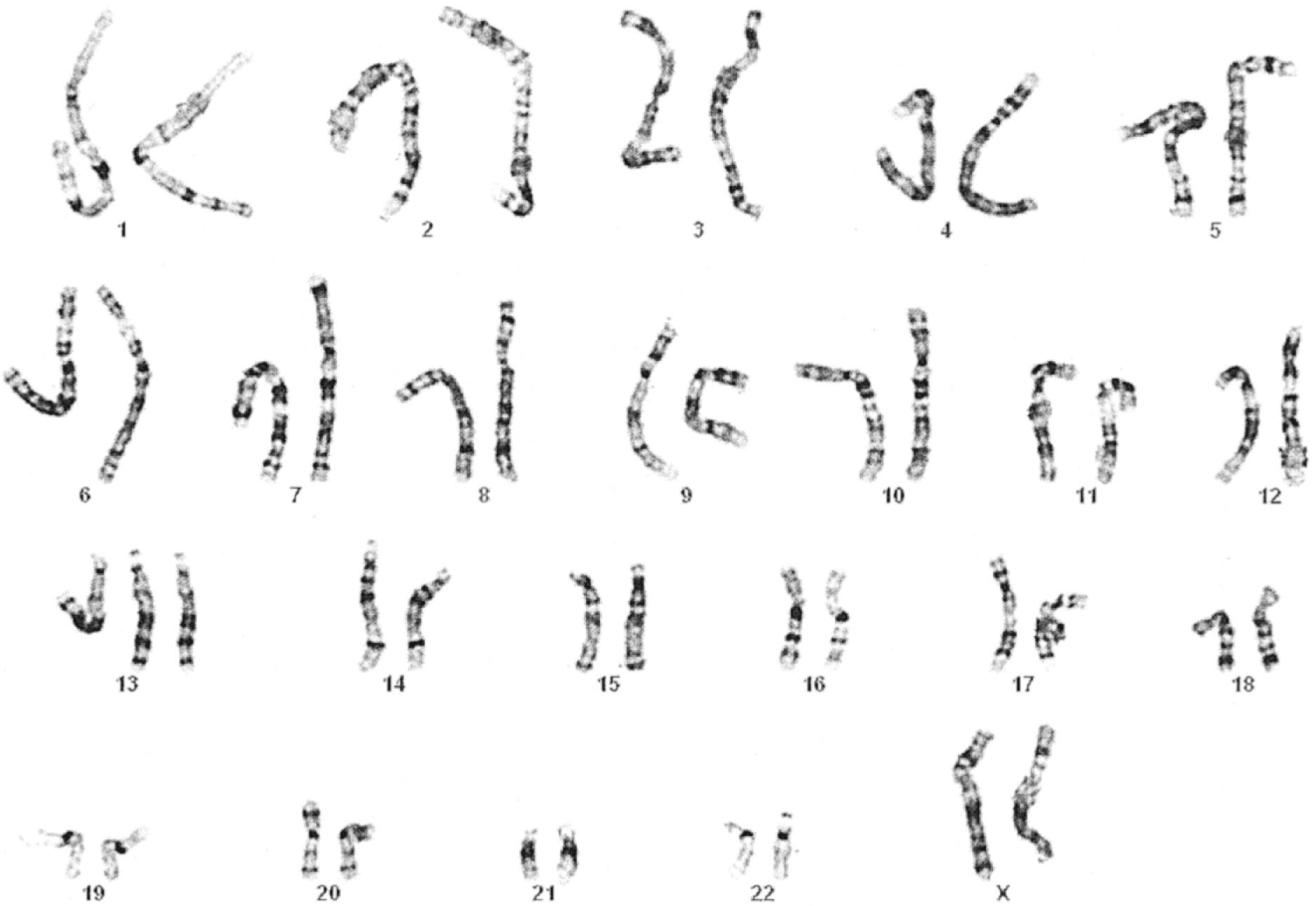 Fig. 1.8, Karyotype of a patient with trisomy 13 demonstrates aneuploidy. Note the extra chromosome 13, causing the cell to have 47 instead of 46 chromosomes.