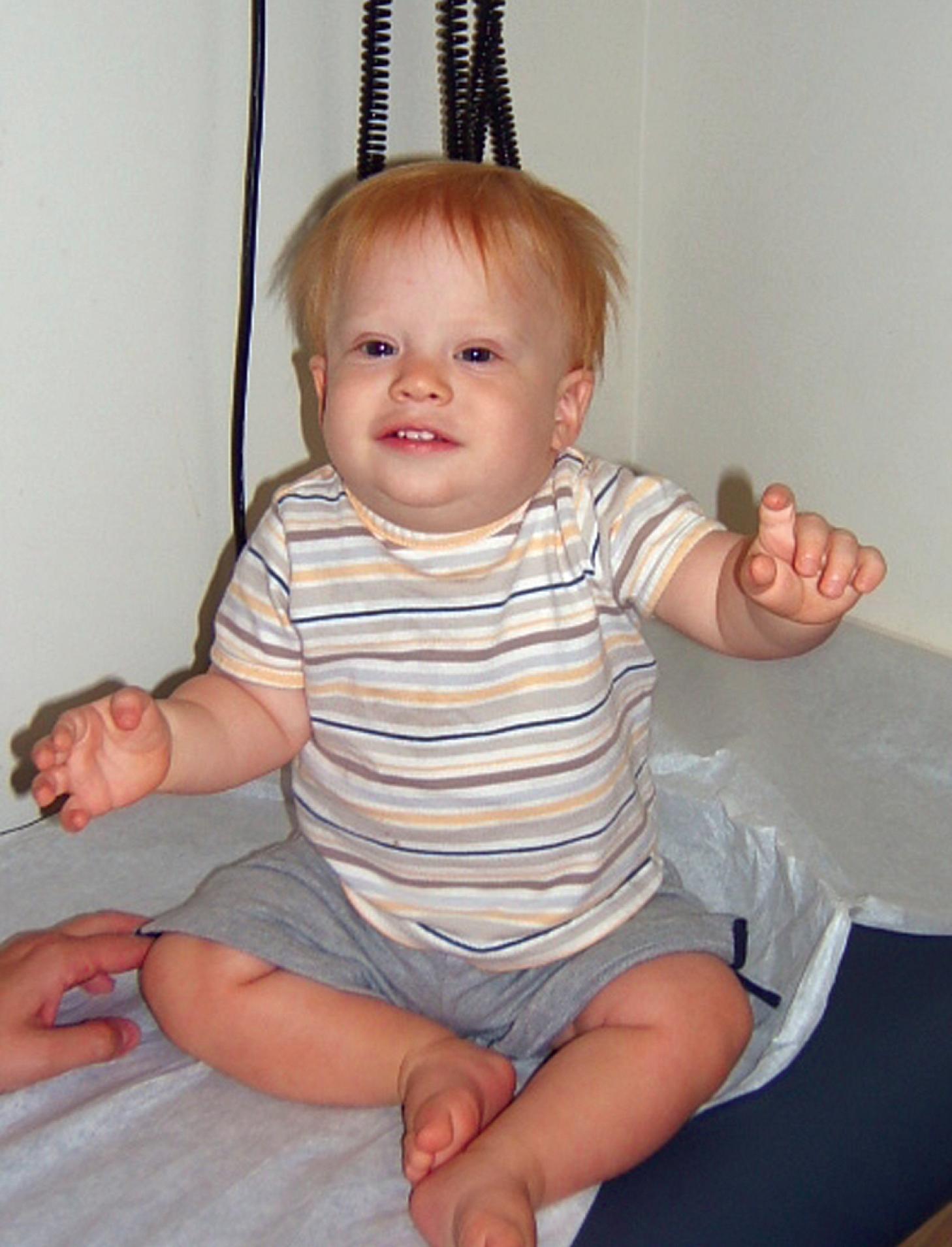 Fig. 1.9, A 1-year-old with facies suggestive of Down syndrome. Note the facies and short fifth fingers and clinodactyly. The muscle tone and growth parameters were normal. Cytogenetics studies showed 2% of the cells with 47,XY+21; interphase fluorescence in situ hybridization studies with an extra cell count showed trisomy 21 in 1.3% of 523 peripheral lymphocytes analyzed.