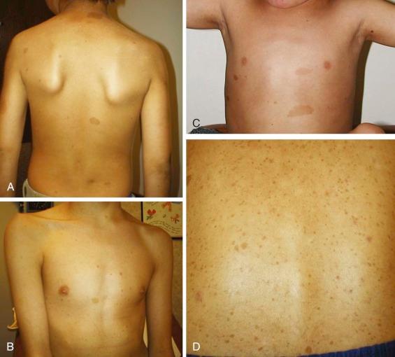 Figure 42-1, Café-au-lait spots in neurofibromatosis type 1 (NF1). ( A to D ). Photographs depicting the appearance of typical café-au-lait spots, as seen in NF1. Café-au-lait spots exhibit distinct edges and are slightly darker than the surrounding skin. Café-au-lait spots can increase in size, number, and darkness throughout childhood. Multiple café-au-lait spots alone are not a definitive indication for NF1; they must be present with other established criteria in order to make the diagnosis. In ( C ), there is also evidence of bilateral axillary freckling.