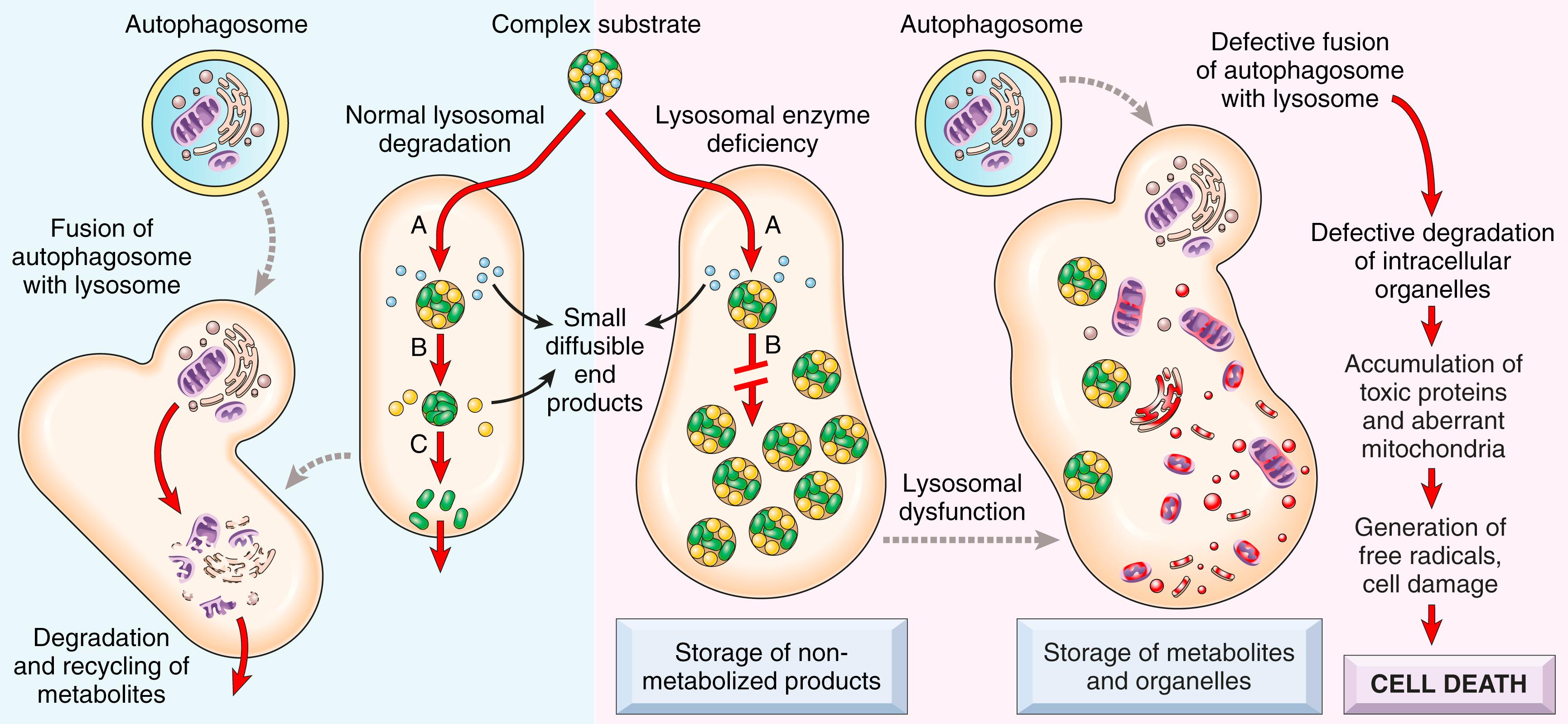 FIG. 4.12, Pathogenesis of lysosomal storage diseases. In this example, a complex substrate is normally degraded by a series of lysosomal enzymes labeled A, B, and C into small soluble end products. If there is a deficiency or malfunction of one of the enzymes (e.g., B), catabolism is incomplete, and insoluble intermediates accumulate in the lysosomes. In addition to this primary storage, secondary storage and toxic effects result from defective autophagy.