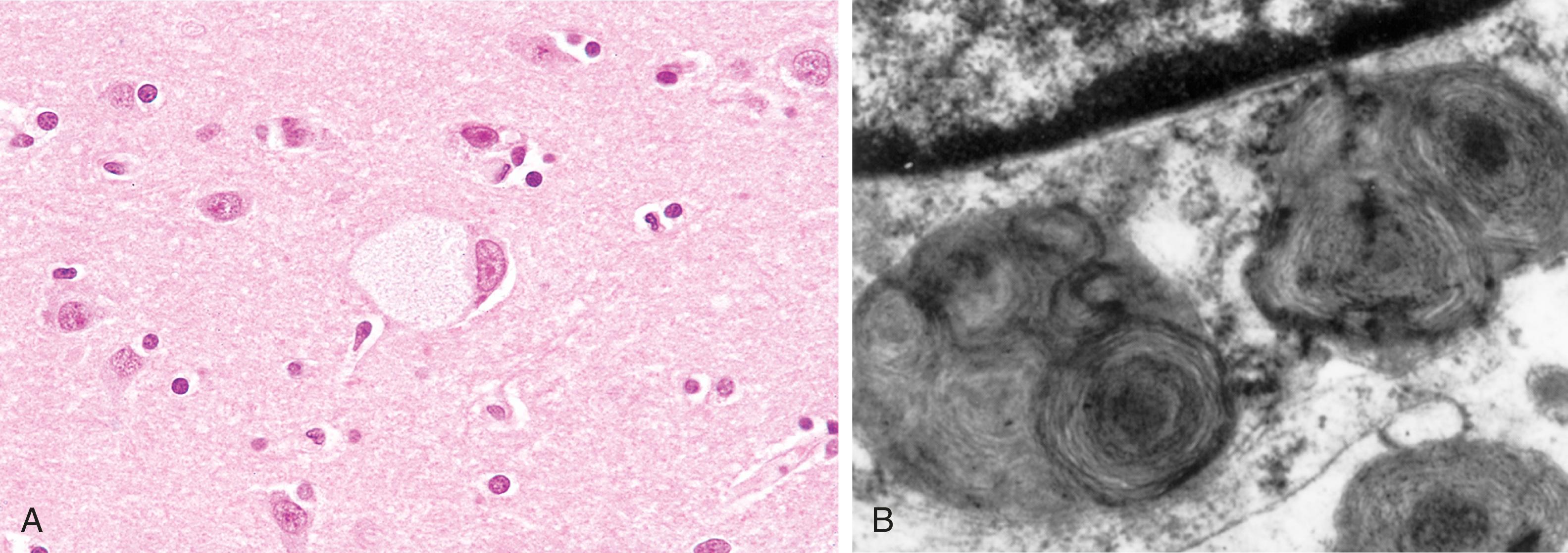 FIG. 4.13, Ganglion cells in Tay-Sachs disease. (A) Under the light microscope, a large neuron has obvious lipid vacuolation. (B) A portion of a neuron under the electron microscope shows prominent lysosomes with whorled configurations just below part of the nucleus.