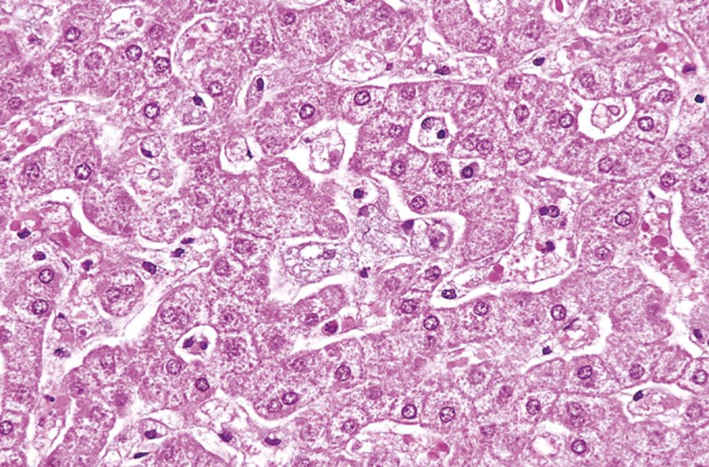 FIG. 4.14, Niemann-Pick type A disease in liver. The hepatocytes and Kupffer cells have a foamy, vacuolated appearance resulting from deposition of lipids.