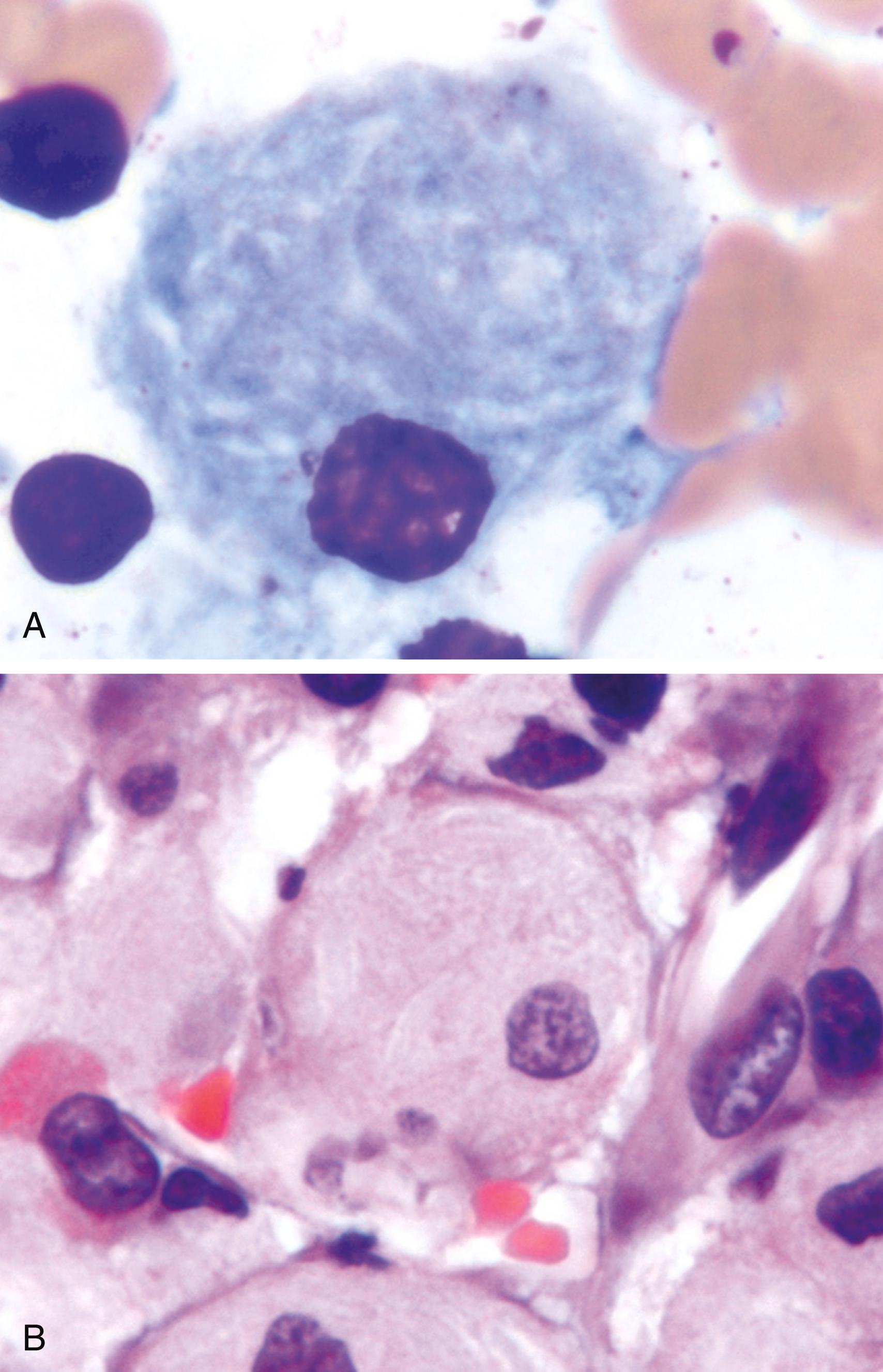 FIG. 4.15, Gaucher disease involving the bone marrow. (A and B) Gaucher cells are plump macrophages that characteristically have the appearance in the cytoplasm of crumpled tissue paper due to accumulation of glucocerebroside. (A) Wright stain; (B) hematoxylin and eosin.