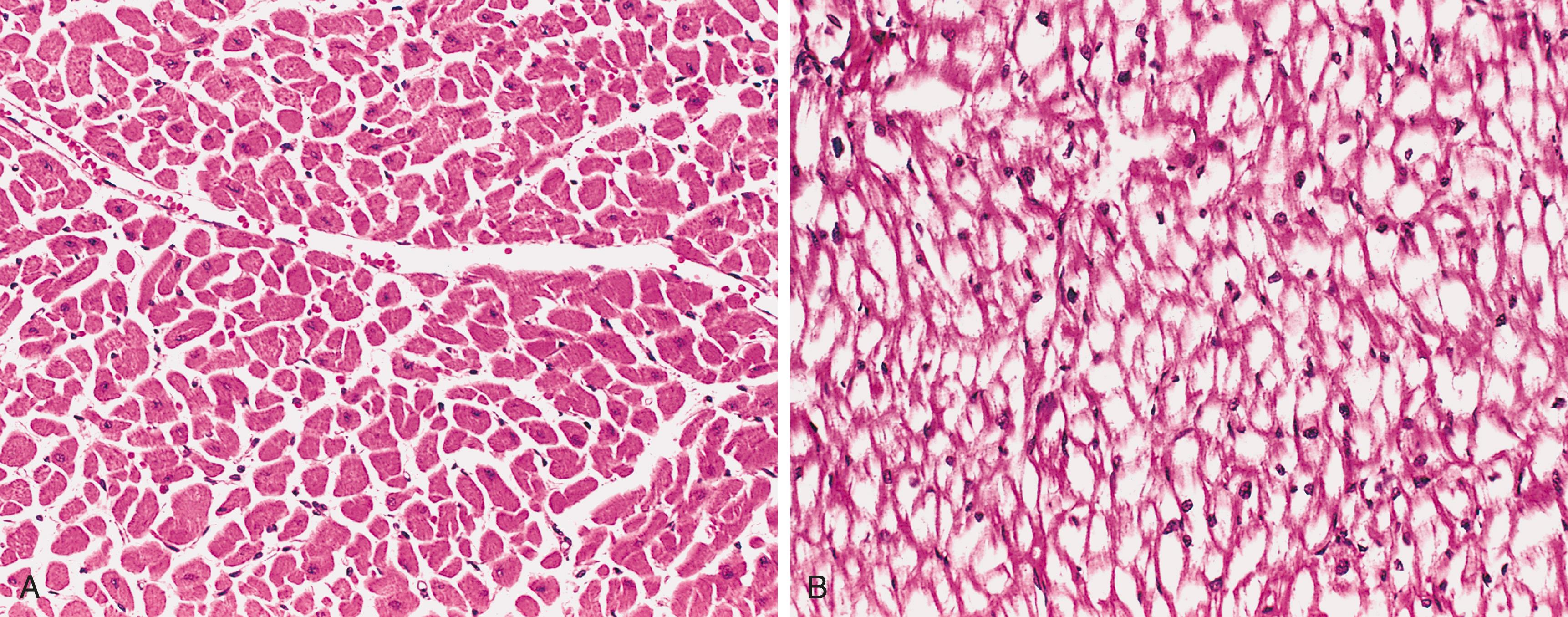 eFIG. 4.1, Pompe disease (glycogen storage disease type II). (A) Healthy myocardium with abundant eosinophilic cytoplasm. (B) Patient with Pompe disease (same magnification) showing the myocardial fibers full of glycogen seen as clear spaces.