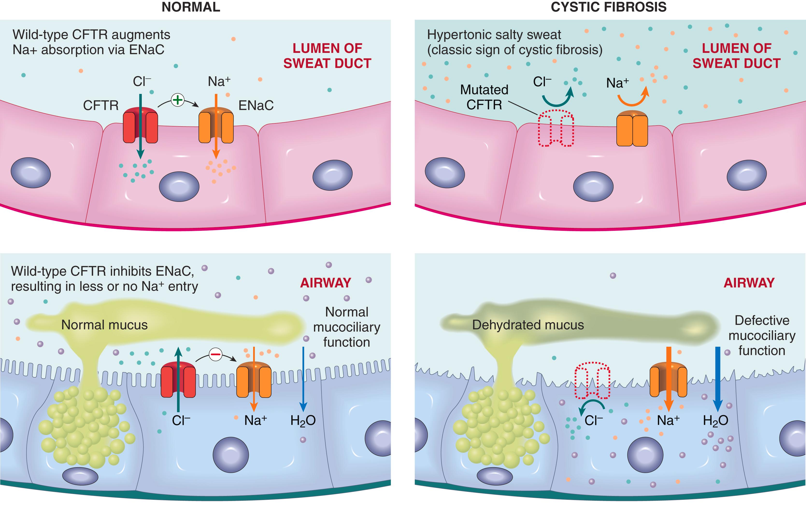 FIG. 4.7, (Top) In cystic fibrosis, a chloride channel defect in the sweat duct causes increased chloride and sodium concentration in sweat. (Bottom ) Patients with cystic fibrosis have decreased chloride secretion and increased sodium and water reabsorption in the airways, leading to dehydration of the mucus layer coating epithelial cells, defective mucociliary action, and mucous plugging. CFTR, Cystic fibrosis transmembrane conductance regulator; ENaC, epithelial sodium channel.