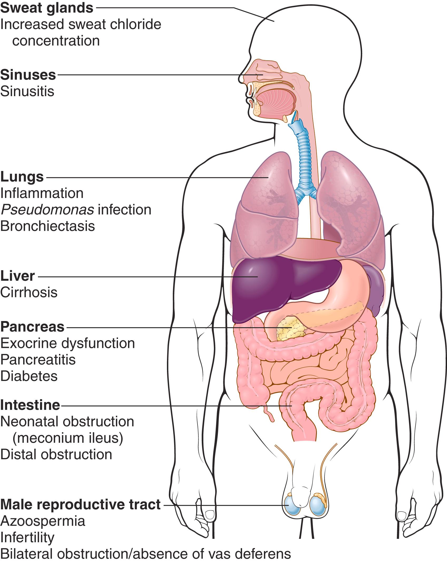 FIG. 4.8, Tissues affected in patients with cystic fibrosis.