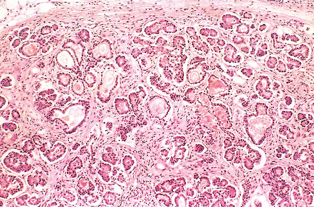 FIG. 4.9, Mild to moderate changes of cystic fibrosis in the pancreas. The ducts are dilated and plugged with eosinophilic mucin, and the parenchymal glands are atrophic and replaced by fibrous tissue.