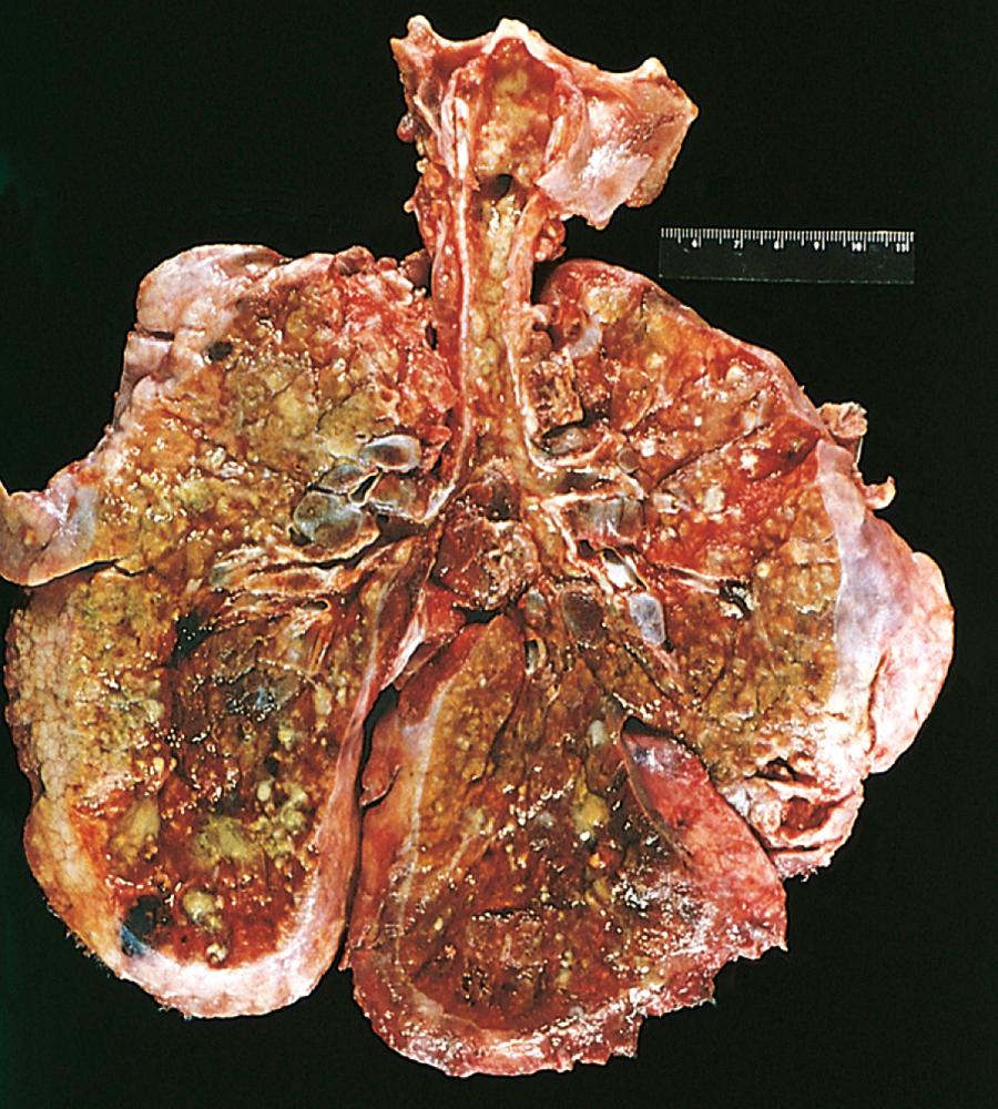 FIG. 4.10, Lungs of a patient who died of cystic fibrosis. Extensive mucous plugging and dilation of the tracheobronchial tree are apparent. The pulmonary parenchyma is consolidated by a combination of both secretions and pneumonia; the greenish discoloration is the product of Pseudomonas infections.