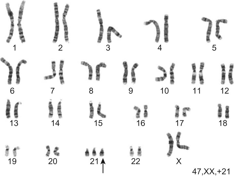 Fig. 9.1, Karyotype showing trisomy 21.