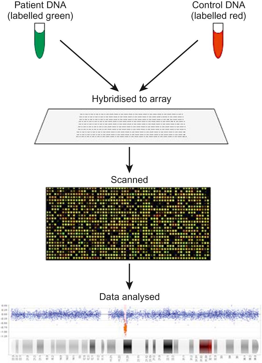 Fig. 9.3, Schematic diagram of array-CGH testing in a child with Williams syndrome. Patient and control DNA samples are labelled with different dyes and hybridized to an array with many thousand immobilized oligonucleotide probes for specific regions of the genome. The array is scanned and the data analysed to detect regions of deletion (which fluoresce red due to an excess of control DNA) or duplication (which fluoresce green due to an excess of patient DNA). Here, the array has detected a deletion at chromosome position 7q11.23, indicating Williams syndrome.