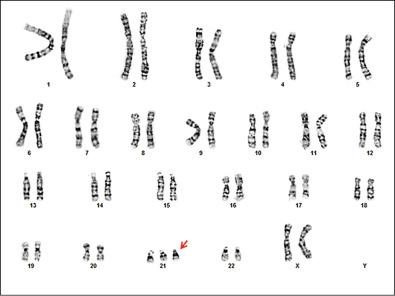 FIG 2-3, Trisomy 21 karyotype. G-banded karyotype of a female with trisomy 21 (Down syndrome; 47,XX,+21).