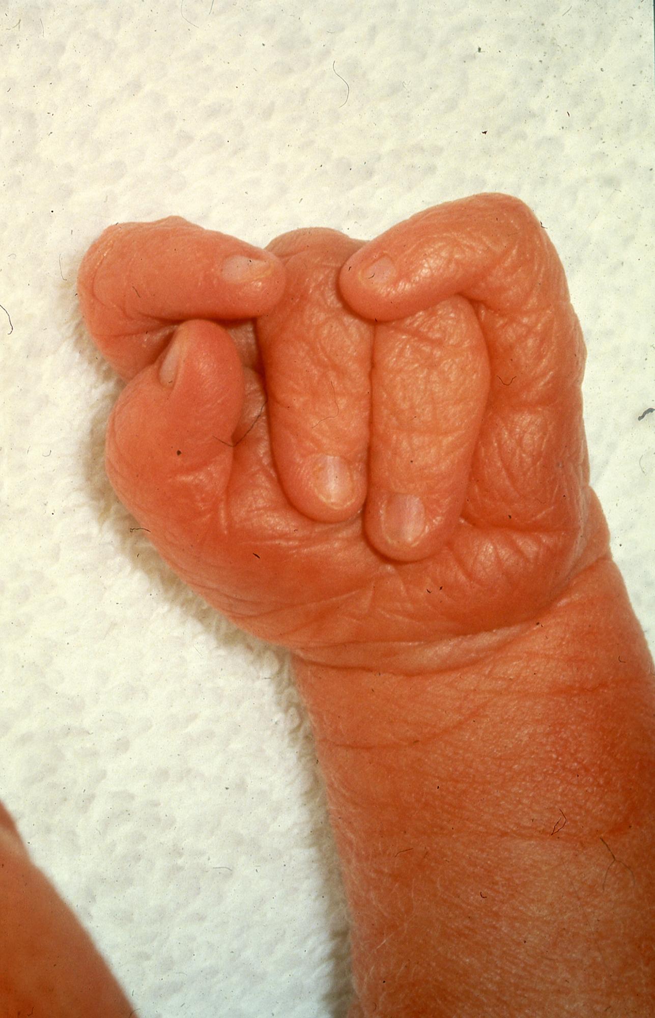 Fig. 5.3, Characteristic appearance of the hand in Edward syndrome