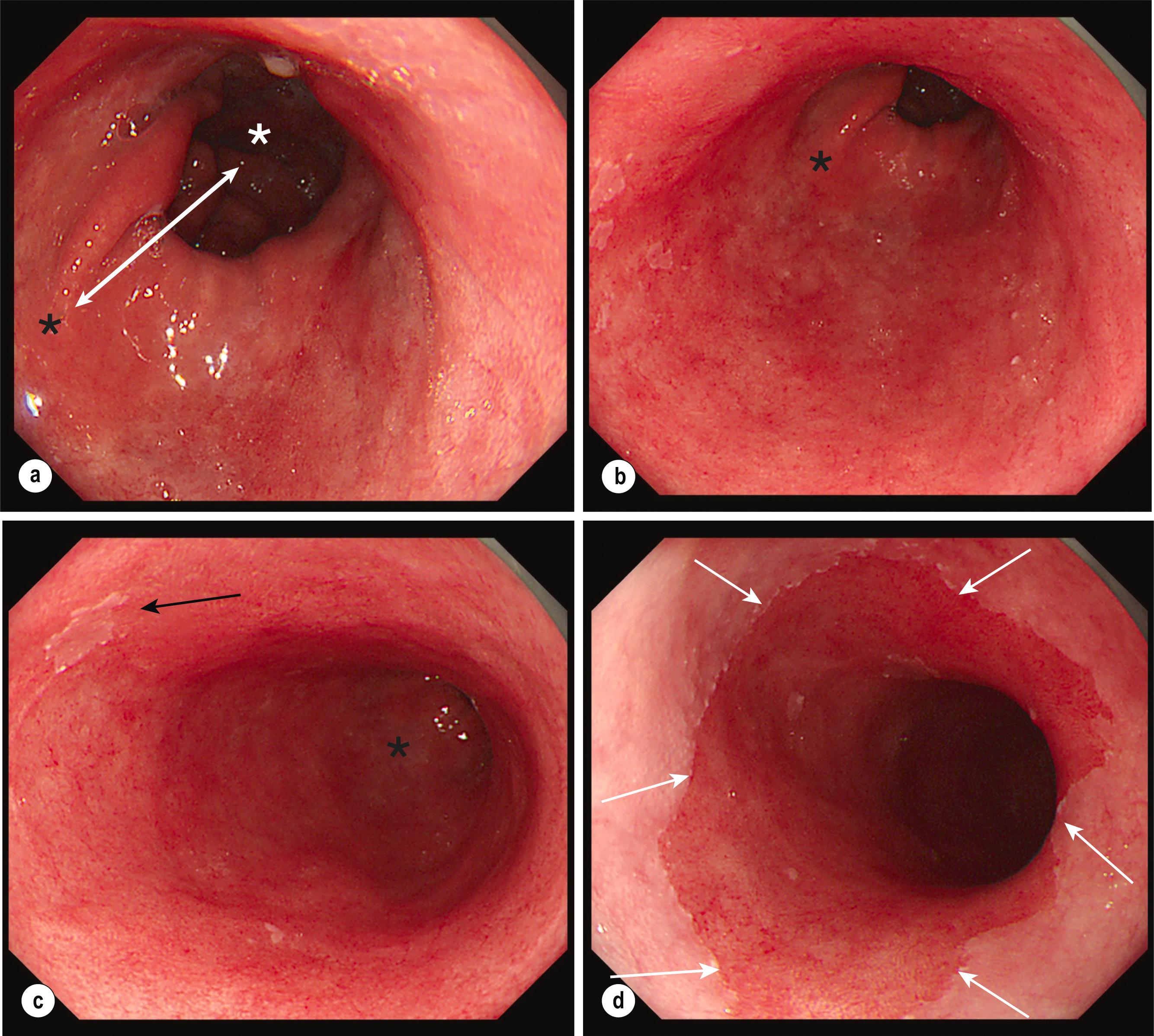 Figure 2.1, White light endoscopy images of a case of long Barrett’s oesophagus (BO) with a hiatus hernia and diagnostic landmarks. (a) The distance between the diaphragmatic pinch (white asterisk) and the oesophagogastric junction (OGJ), identified as the top end of the gastric folds (black asterisk) , is increased and represents the size of the hiatus hernia (white double arrow) , a known risk factor for gastro-oesophageal reflux (GORD) and BO. (b and c) Panoramic views of at two levels of the BO segment with the OGJ (black asterisks) visible at the bottom end of the BO, where the normal squamous mucosa has been replaced by a salmon-coloured segment of columnar epithelium extending well beyond the OGJ, suggesting the presence of BO. A small island of squamous epithelium is present (black arrow) . The squamo-columnar junction (SCJ), i.e. the transition from the squamous mucosa of the oesophagus to the columnar mucosa of the stomach, which coincides with the OGJ in a healthy states, is not visible in this case of BO. (d) Upon further withdrawal of the endoscope, the upper border of the long BO is visible. The SCJ is visible in the mid-oesophagus with transition from the salmon pink columnar Barrett’s mucosa to the whitish-pink squamous mucosa of the healthy oesophagus (white arrows) .