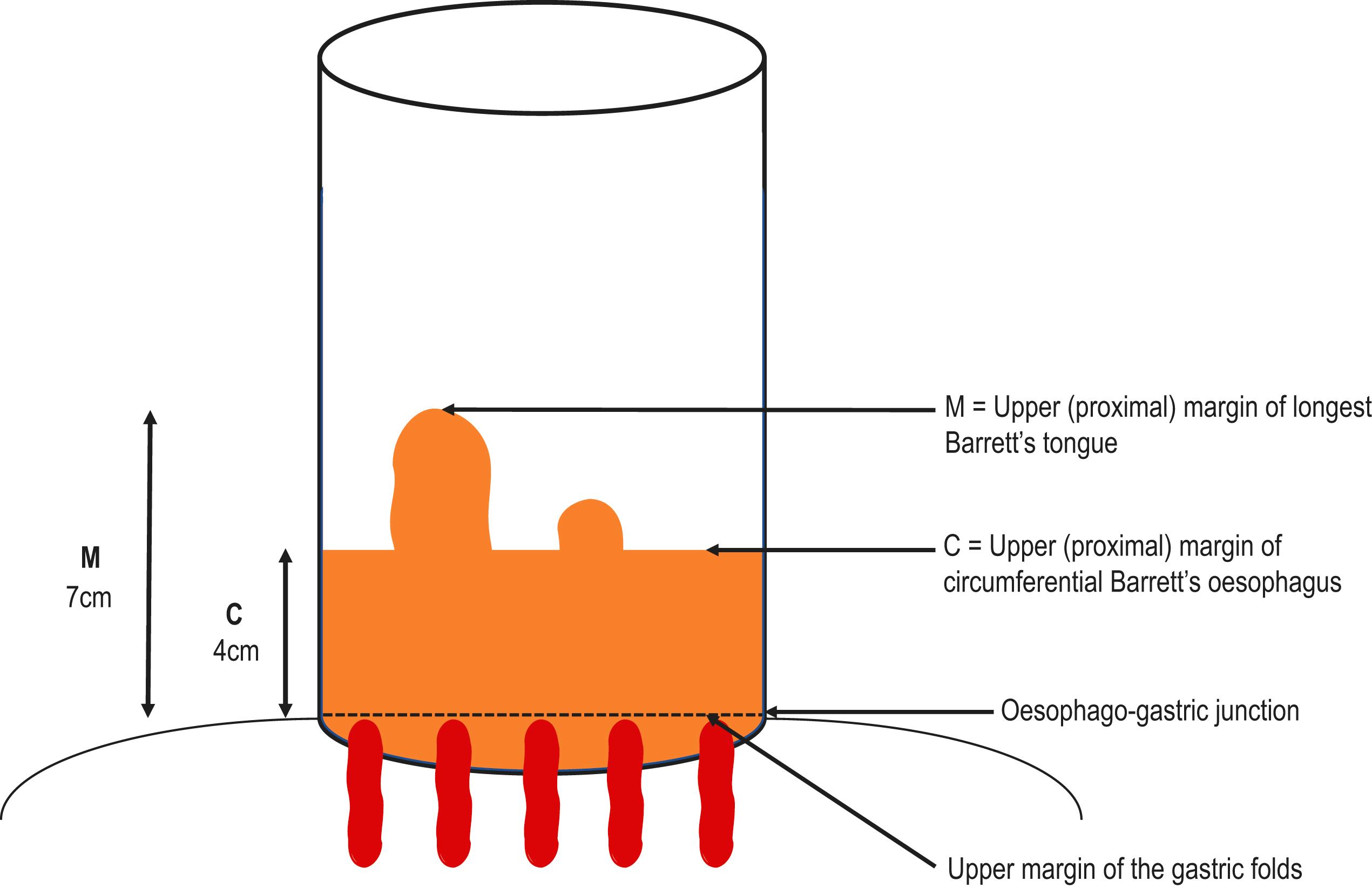 Figure 2.3, The evaluation of Barrett’s oesophagus (BO) based on the Prague classification. The oesophagogastric junction is found at the top of the gastric folds, coincinding with the squamo-columnar junction (SCJ) in a healthy oesophagus. This is no longer the case in the presence of BO, as the SCJ is located more proximally. According to the Prague classification, the BO segment is measured based on the circumferential extent (C) and the maximal extent (M) . In the case showed in this example, the circumferential extent is 4 cm and the maximal extent is 7 cm, hence reported as C4M7.