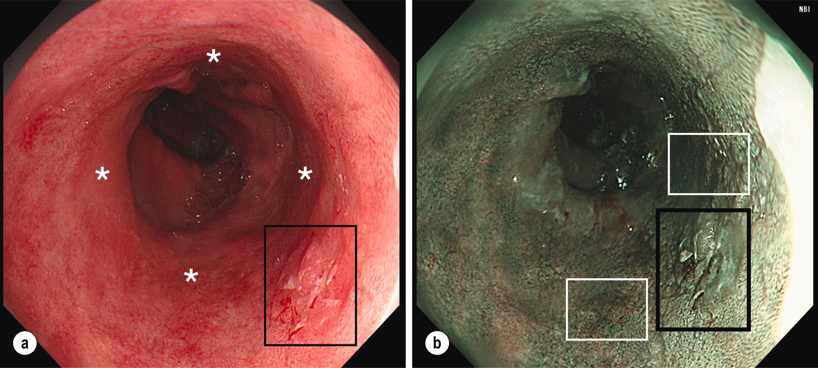 Figure 2.4, A case of long-segment Barrett’s oesophagus (BO) with a superficial neoplastic lesion. (a) White light endoscopy image of long-segment BO with a Paris 0–IIb superficial lesion with surface ulceration at the 4 o’clock position (black box) . Biopsy histology showed intramucosal adenocarcinoma (IMC). In such a case biopsies should be taken from all four quadrants (white asterisks) every 2 cm as well as from the visible lesion. (b) Narrow-band imaging (NBI) reveals that the underlying pathology is more extensive than that seen on WLE, with dysplastic-looking areas at the 3 and 6 o’clock positions (white boxes) in addition to the main lesion (black box) .