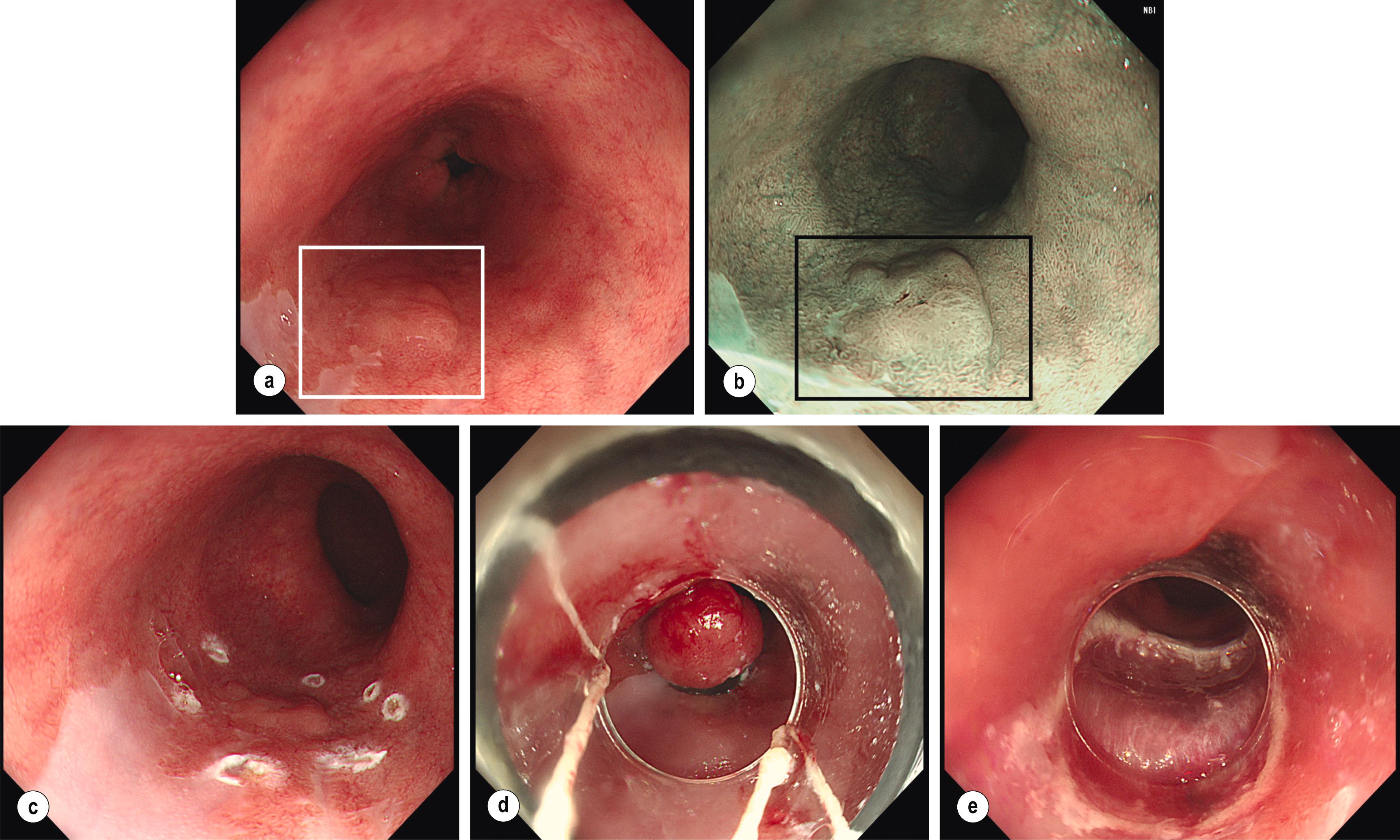 Figure 2.5, Detection, assessment and endoscopic treatment of superficial neoplastic lesion in Barrett’s oesophagus (BO). (a) White light endoscopy (WLE) of a BO segment with a superficial, slightly elevated (Paris 0–IIa) lesion at 7 o’clock (white box) . (b) Narrow-band imaging of the same area allows better visualisation of the lesion and sharper delination of its margins (black box) . Biopsies showed high-grade dysplasia (HGD), and endoscopic mucosal resection (EMR) was decided. (c) WLE imaging showing the markings made around the HGD lesion in preparation for EMR. (d) WLE imaging of the multiband mucosectomy device with the HGD lesion trapped in the rubber band. (e) WLE imaging of the area following EMR resection of the HGD lesion.