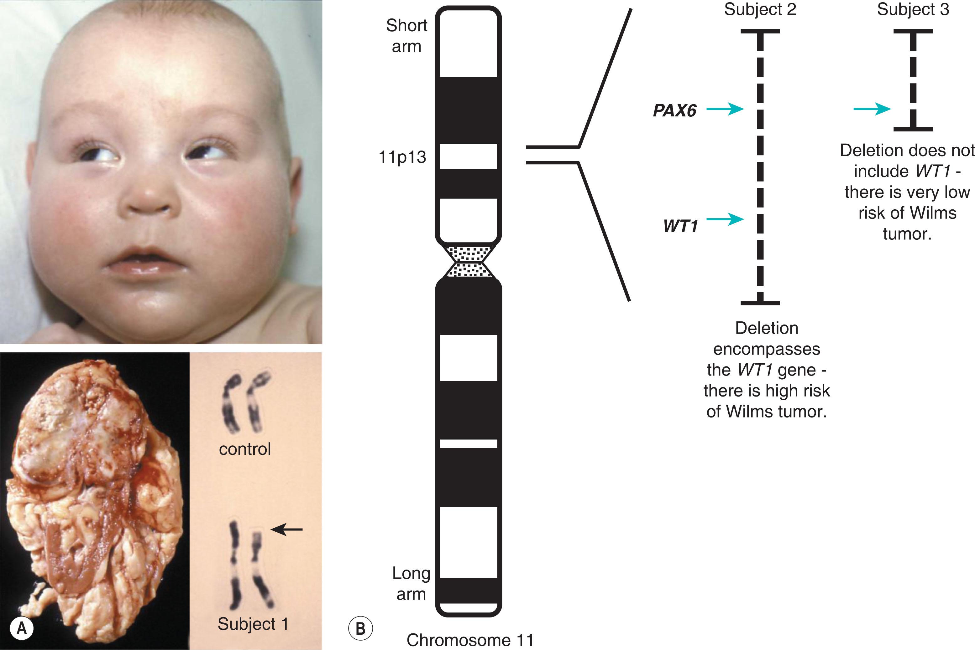 Fig. 10.3, Aniridia caused by deletions in chromosome 11. (A) A child presented with cognitive impairment, genitourinary abnormalities, and aniridia (subject 1, top row); there was no relevant family history. He was subsequently found to have a Wilms tumor in the superior pole of his kidney (bottom row, left). Karyotype analysis revealed a deletion in the short arm of chromosome 11, which encompasses the PAX6 (aniridia) and the WT1 (Wilms tumor) genes (bottom row, right; arrow highlights the deleted region). (B) Subjects 2 and 3 were born with sporadic aniridia. Karyotype analysis was normal but further cytogenetic analysis revealed submicroscopic deletions in both patients. The deletion in Subject 2 removed a copy of the PAX6 and WT1 genes (deletion shown as interrupted line). The deletion in Subject 3 was smaller and only removed a copy of the PAX6 gene; the WT1 gene was unaffected with two normal copies. Consequently, Subject 2 is at high risk of developing Wilms tumor (one WT1 gene copy), while Subject 3 is not at risk (two WT1 gene copies).