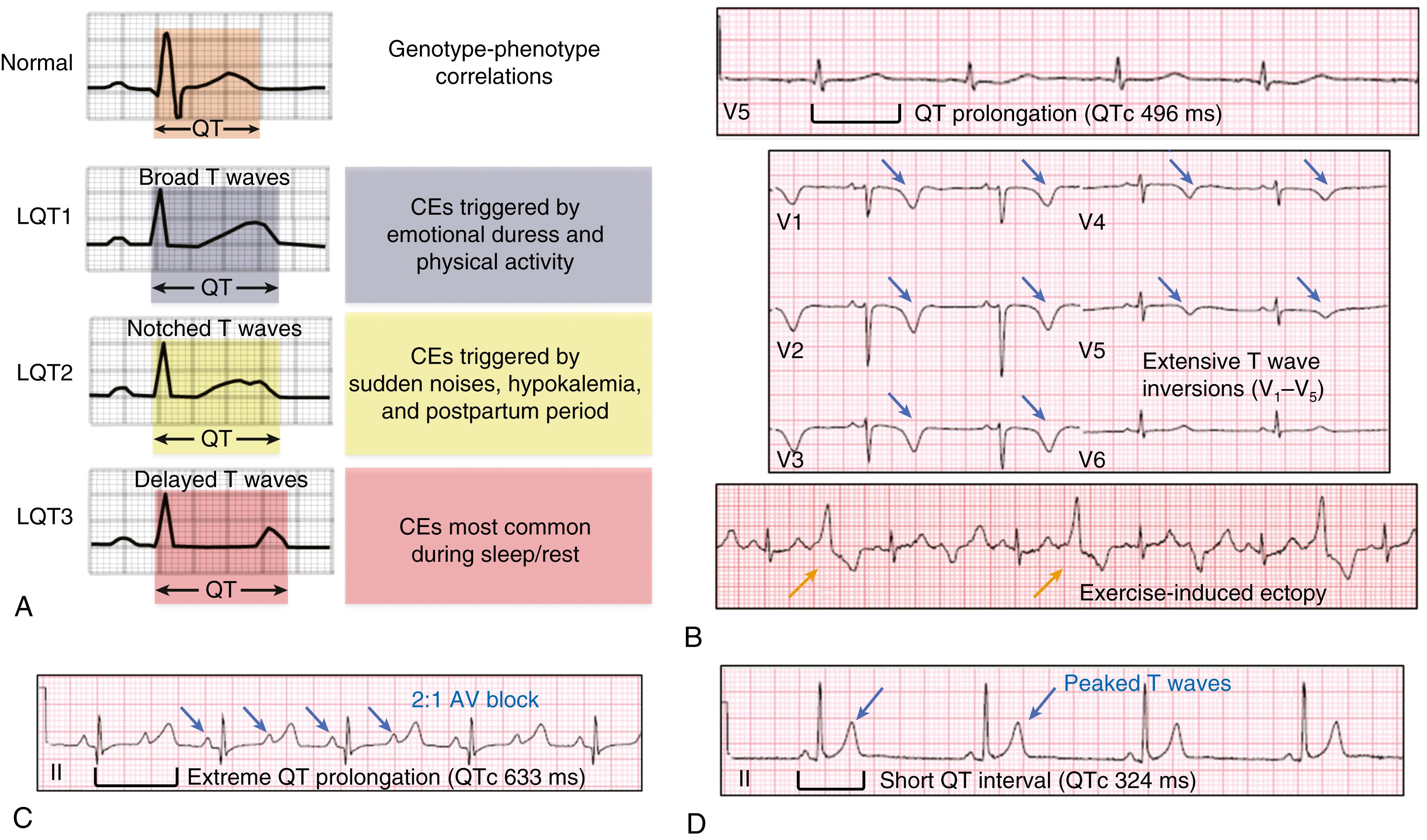 FIGURE 63.1, Notable electrocardiographic findings in the QT-opathies. A, Canonical (i.e., LQT1-3) long QT syndrome genotype-specific electrocardiogram patterns and clinically relevant genotype-phenotype correlations. B, QTc prolongation (top panel, black bracket ), extensive precordial T wave inversions (middle panel, blue arrows ), and exercise-induced ventricular ectopy (bottom panel, orange arrows ) observed in a triadin knockout syndrome patient homozygous for p.D18fs∗13-TRDN. C, Rhythm strip from a Timothy syndrome patient harboring p.G406R-CACNA1C that displays extreme QTc prolongation ( black bracket ) and 2:1 atrioventricular block ( blue arrows ). D, Rhythm strip from a patient with short QT syndrome displaying characteristic QTc shortening ( black bracket ) and peaked T waves ( blue arrows ). AV, Atrioventricular; CEs, cardiac events; QTc, heart rate-corrected QT interval.