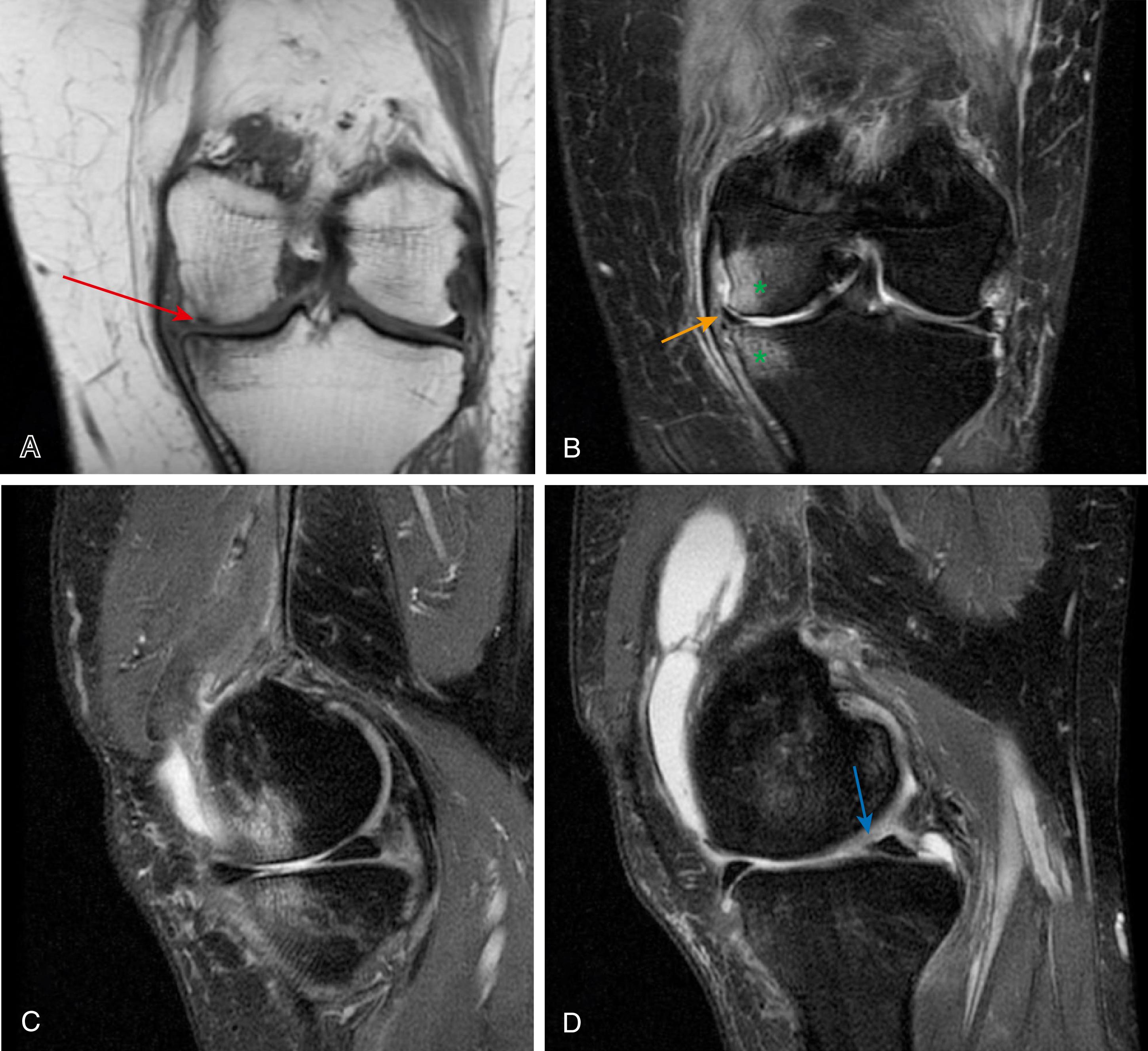FIG. 173.1, Magnetic resonance imaging of the left knee: coronal T1-W (A) images demonstrating the T1 hypointense subchondral insufficiency fracture line within the medial aspect of the medial femoral condyle measuring 7 mm (red arrow) . (B, C) Coronal proton density fat saturation (PD FS) and sagittal PD FS images at the same level demonstrating the reciprocal bone marrow edema in the medial femoral condyle and medial tibial plateau (asterisks) , as well as a tear of the medial meniscal body (orange arrow) . (D) . Sagittal PD FS image at the level of the posterior horn/root junction of the medial meniscus demonstrating blunting of the medial meniscus compatible with free edge radial tear (blue arrow) .