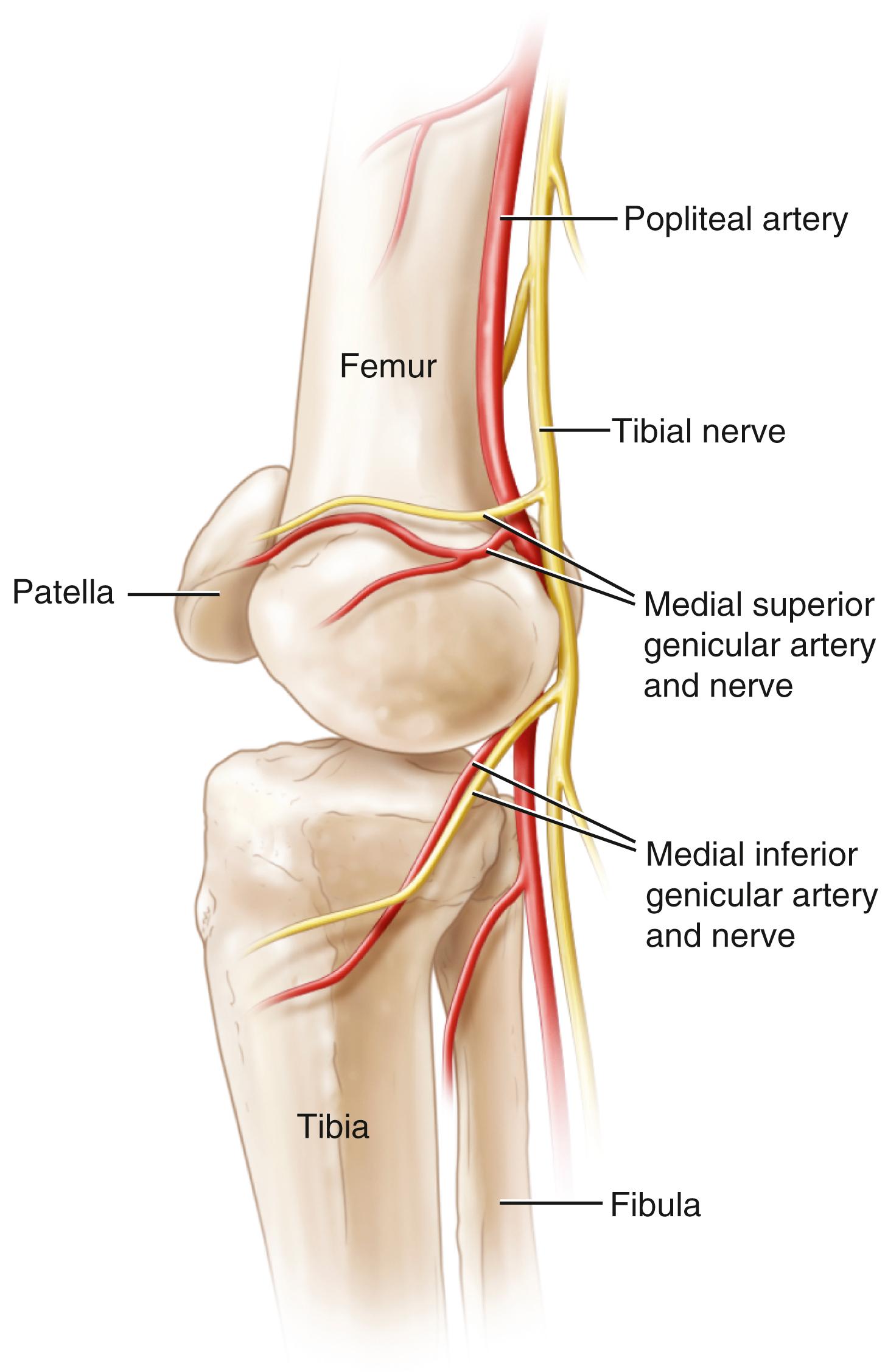 FIG. 173.4, Medial view of the knee demonstrating the relative location of the superior medial genicular nerve and the inferior medial genicular nerve and their corresponding articular arteries.