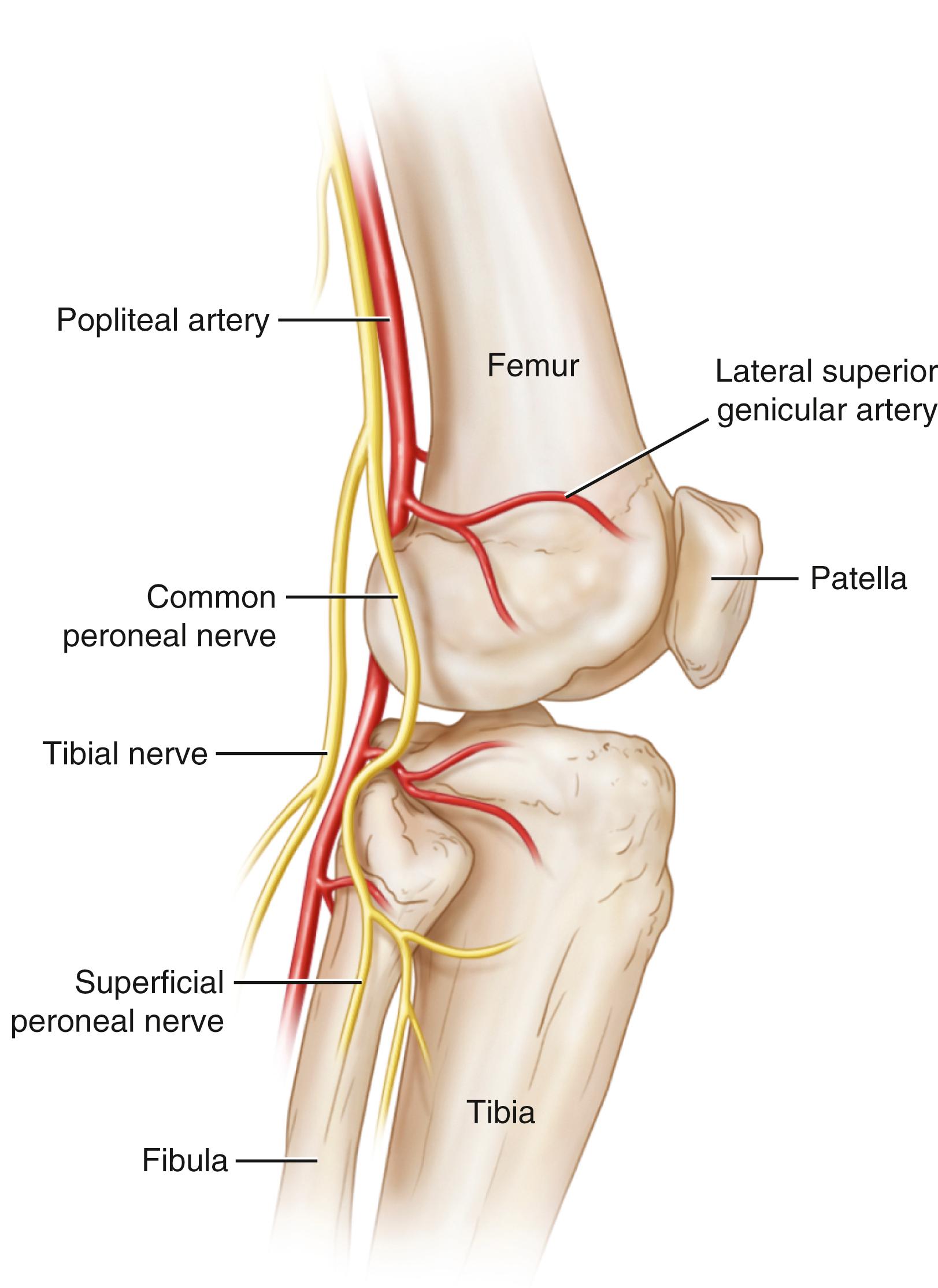 FIG. 173.5, Lateral view of the knee demonstrating the relative location of the superior lateral genicular nerve and the inferior lateral genicular nerve and their corresponding articular arteries.