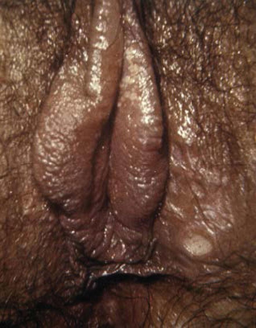 Fig. 23.12, Primary chancre of syphilis.